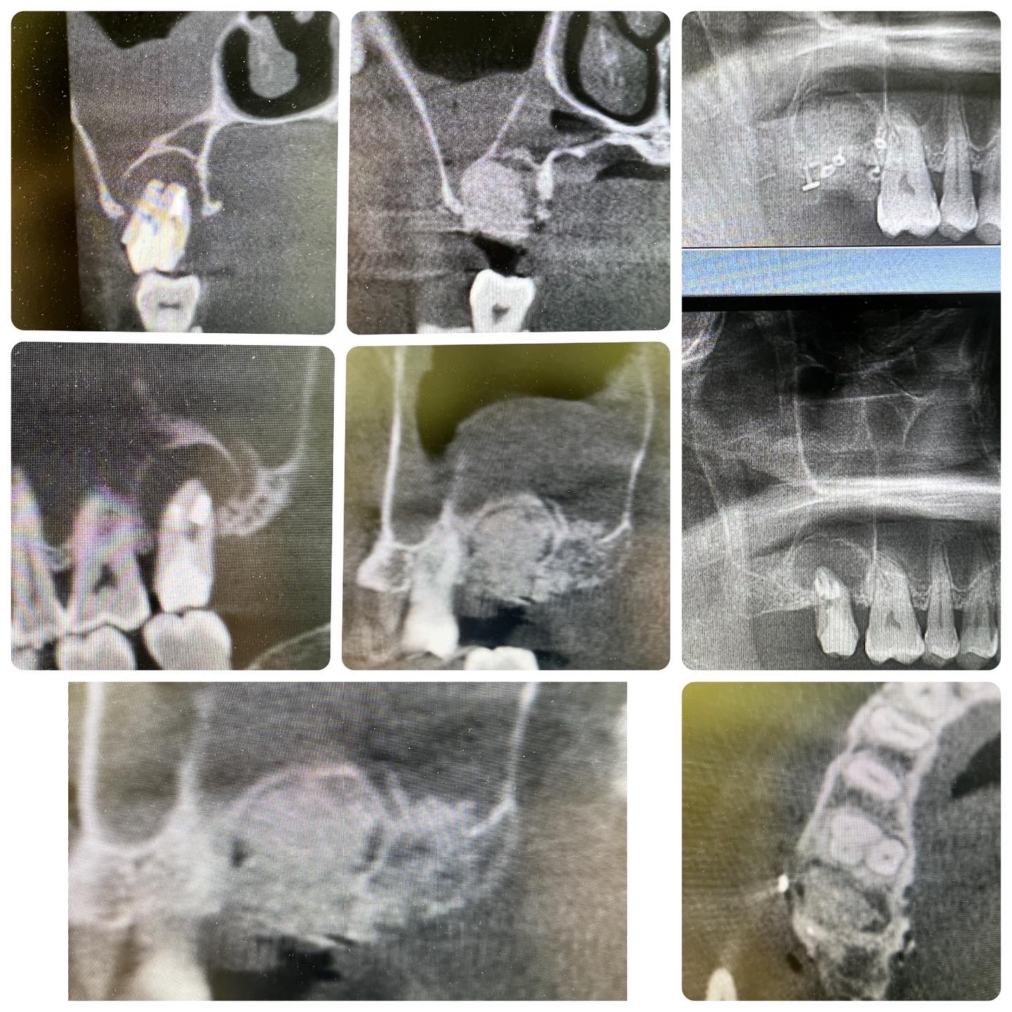 歯を抜くと骨もなくなるから、歯槽堤保存術：ridge preservationをおこなう