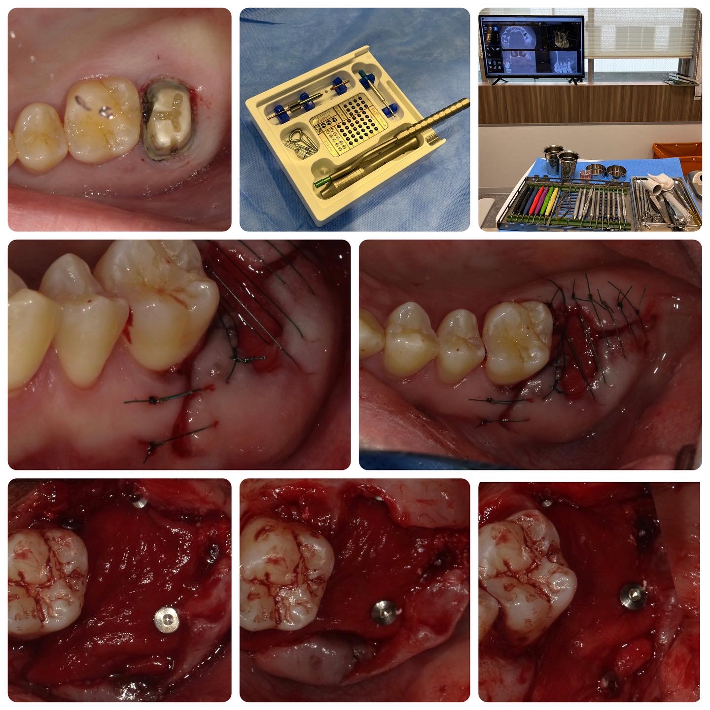 歯を抜くと骨もなくなるから、歯槽堤保存術：ridge preservationをおこなう