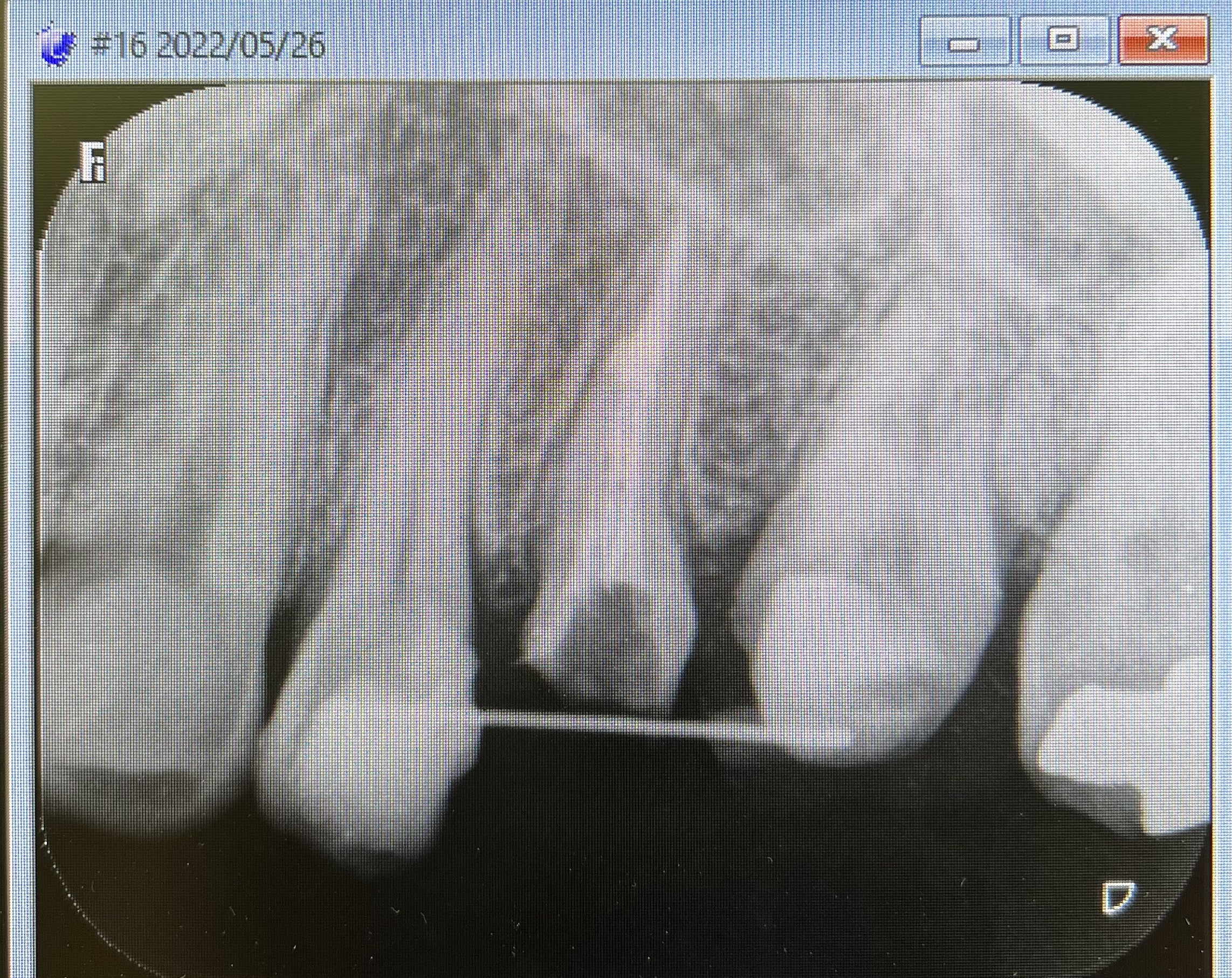 一見抜かれそうな歯を保存。一見抜かれそうな歯髄を保存。
