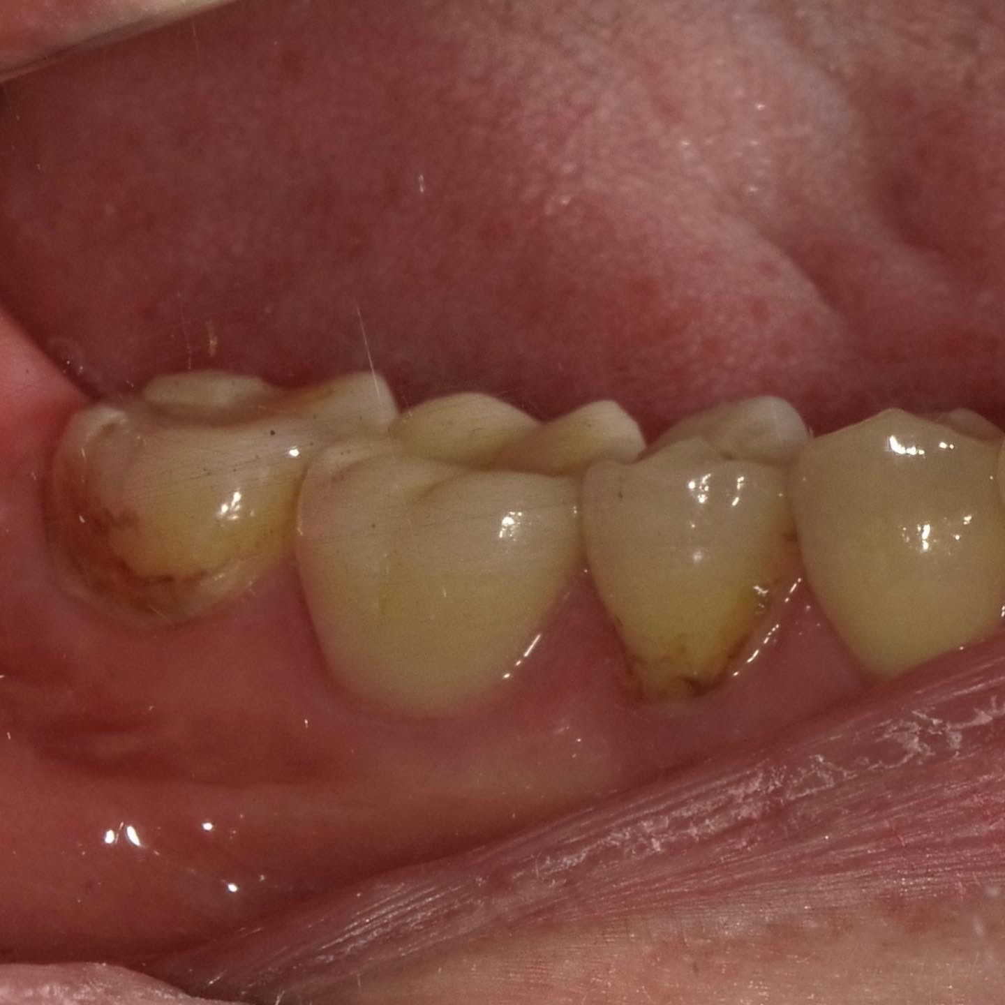 BTAテクニックで歯髄と歯周組織を長期的に守る