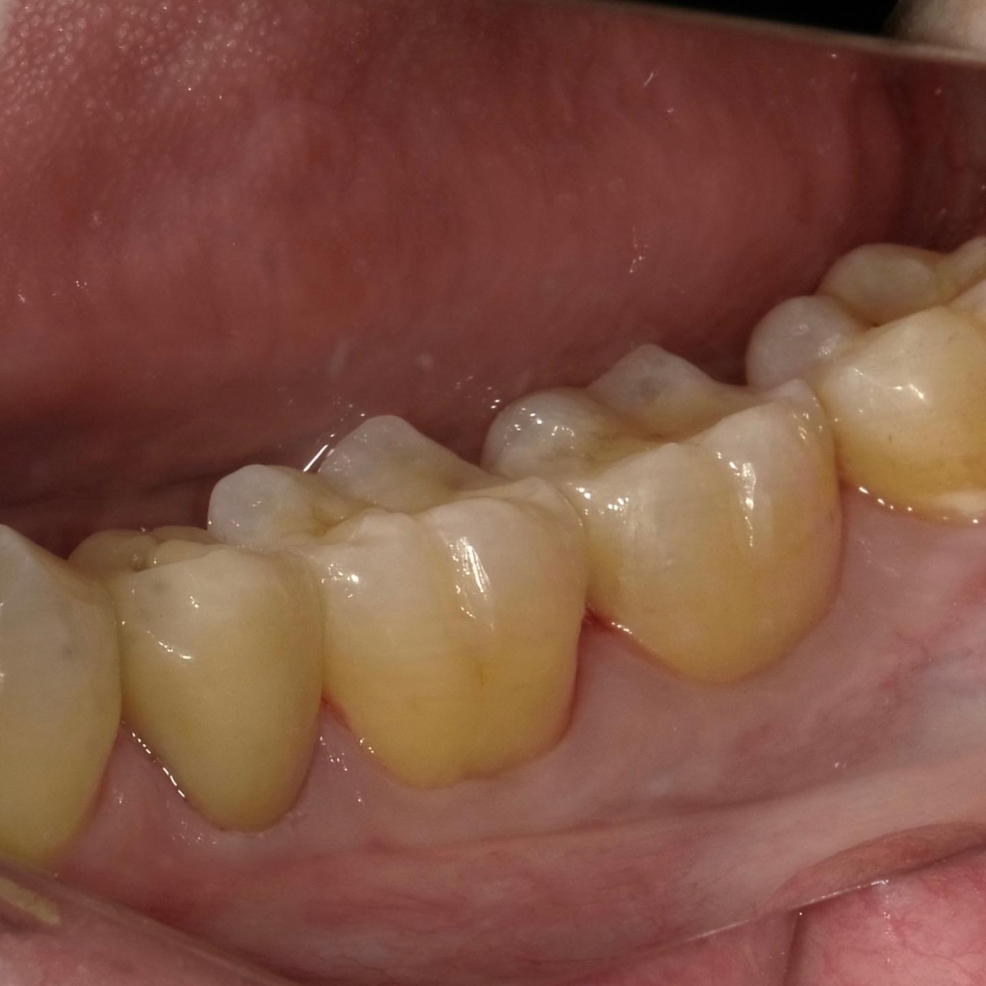 TKDOのセラミックは天然歯模倣