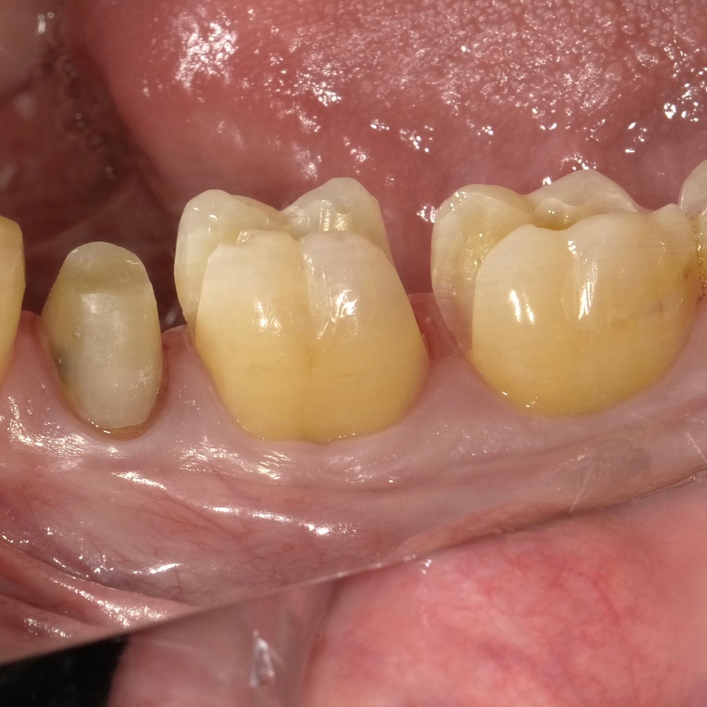 TKDOのセラミックは天然歯模倣