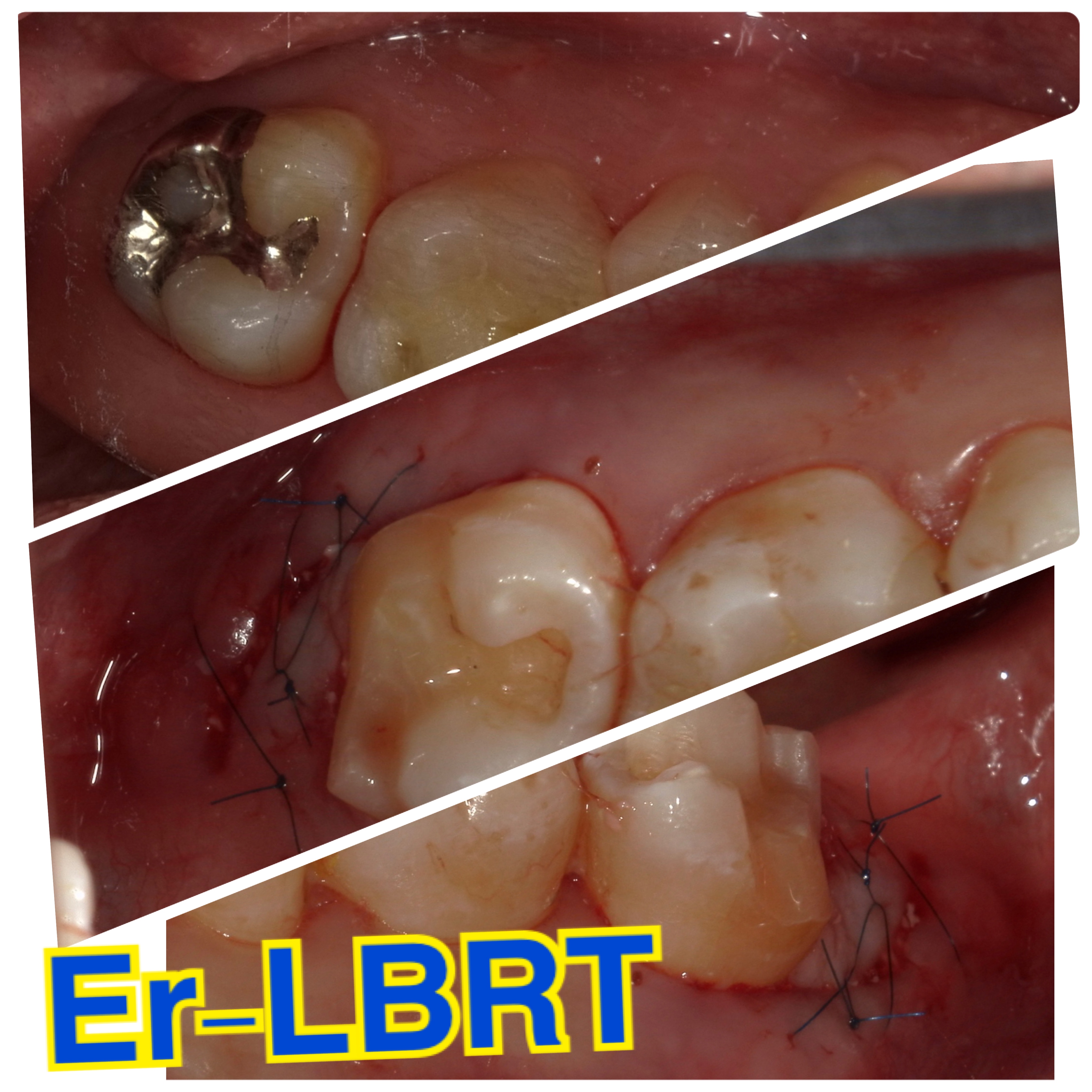 Er-YAGレーザーとエムドゲインゲルによる歯周再生療法