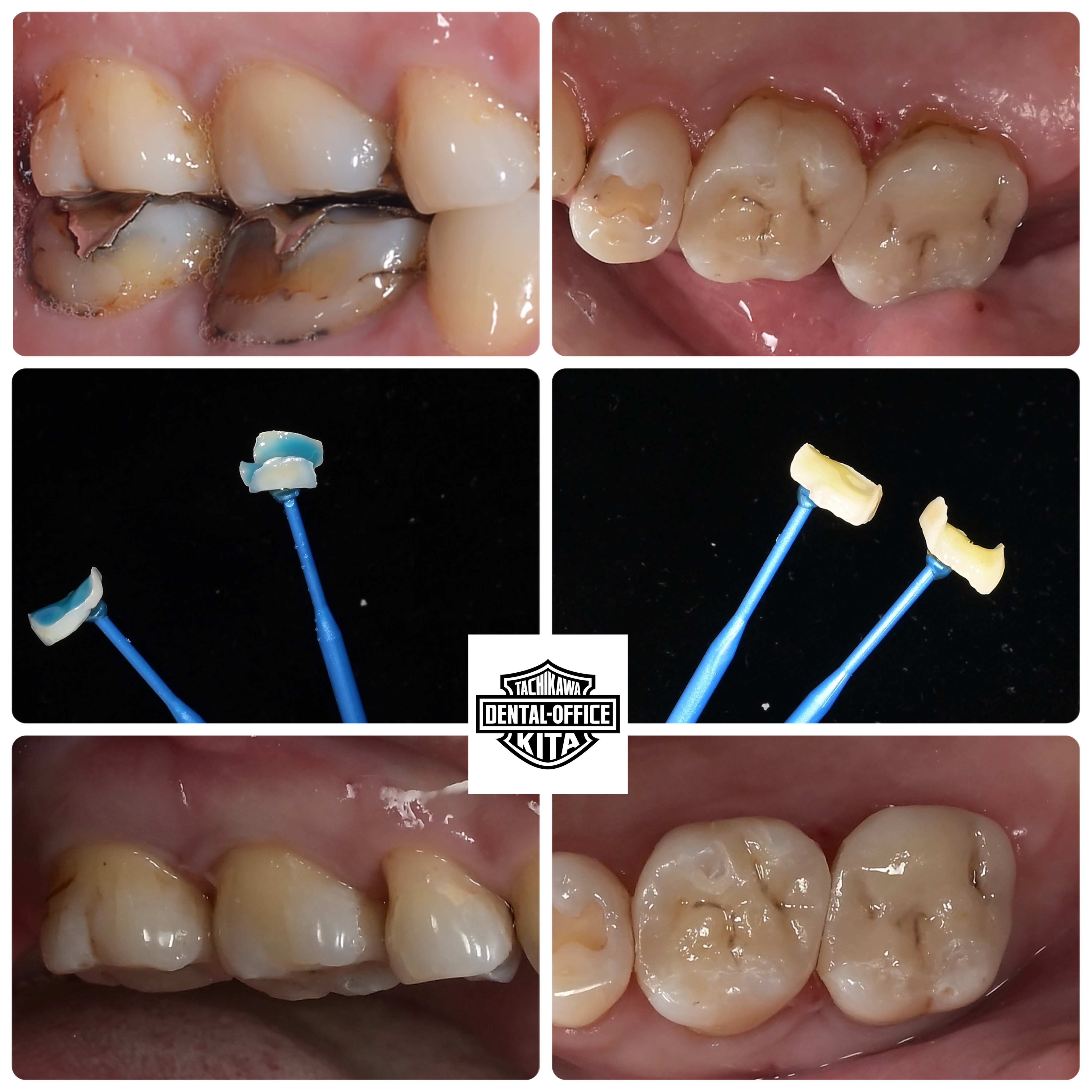 歯を残す歯医者