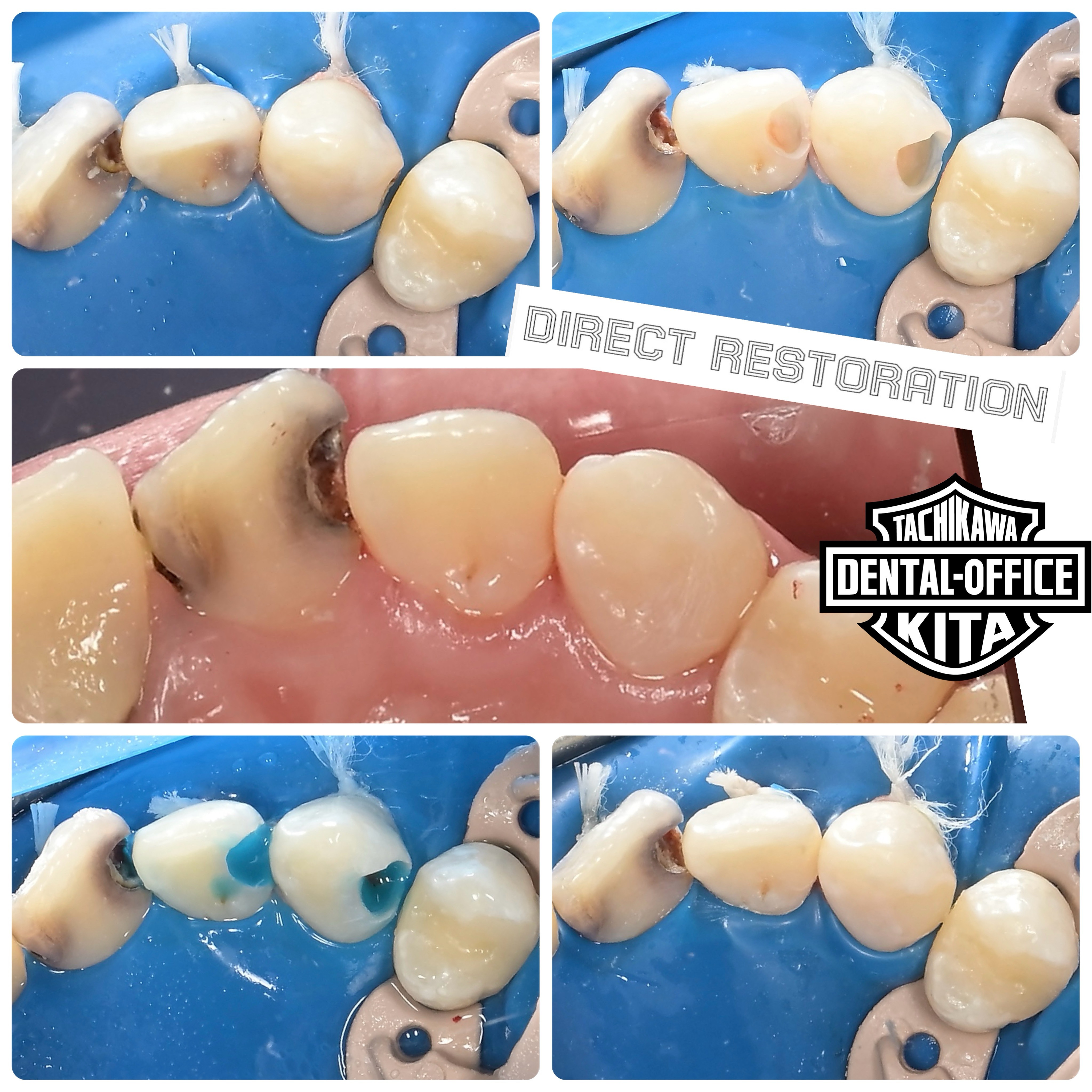 低侵襲Direct Restoration