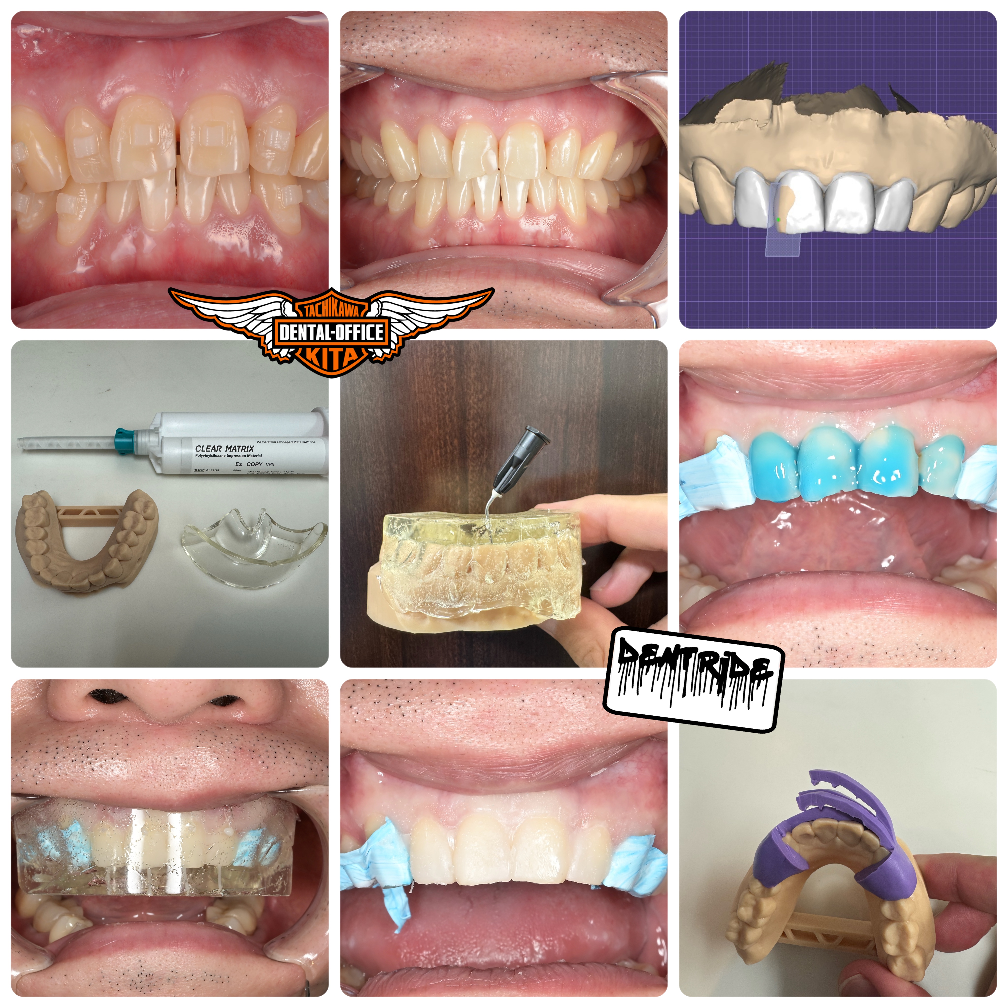 Veneer自信つきました