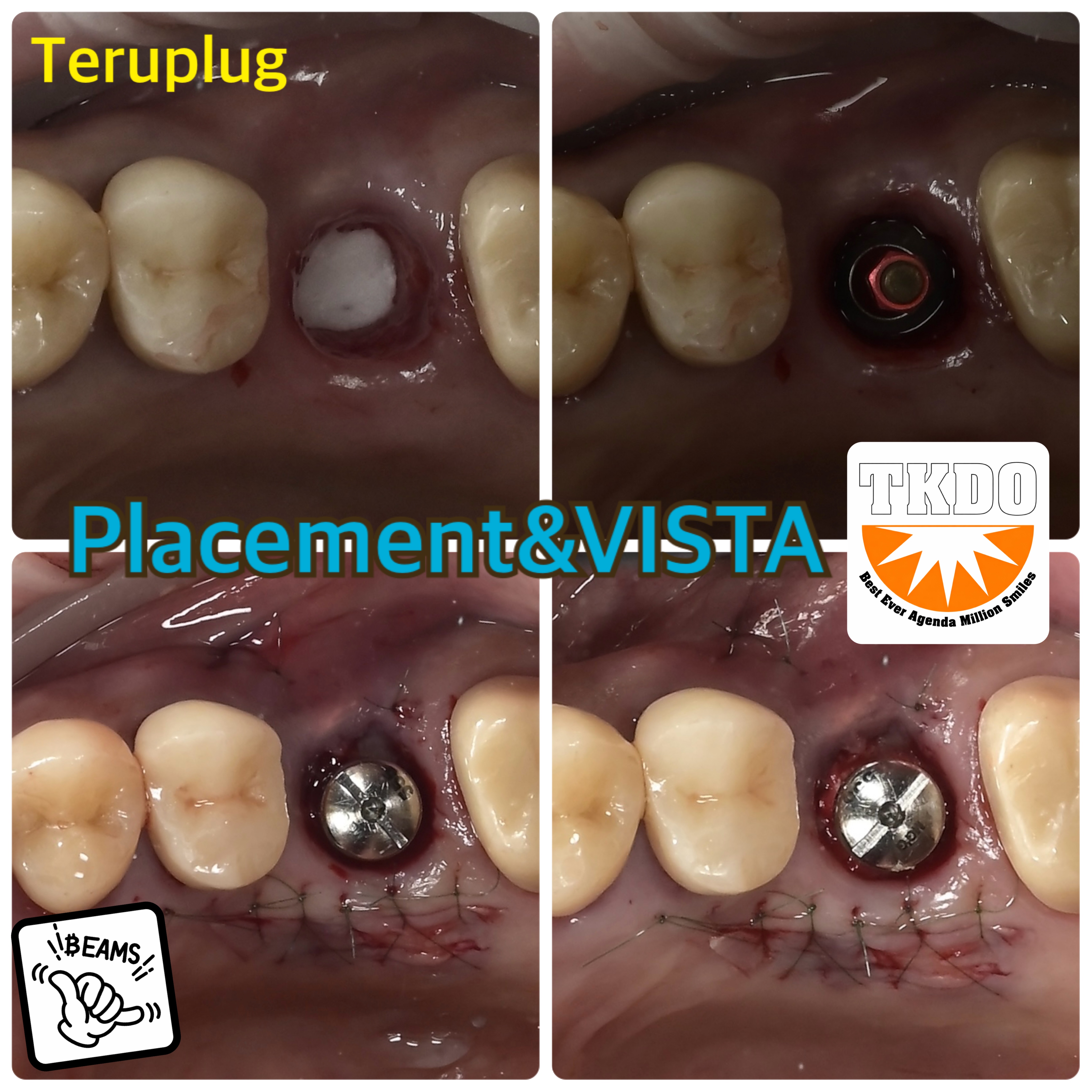 インプラントやりなおし
