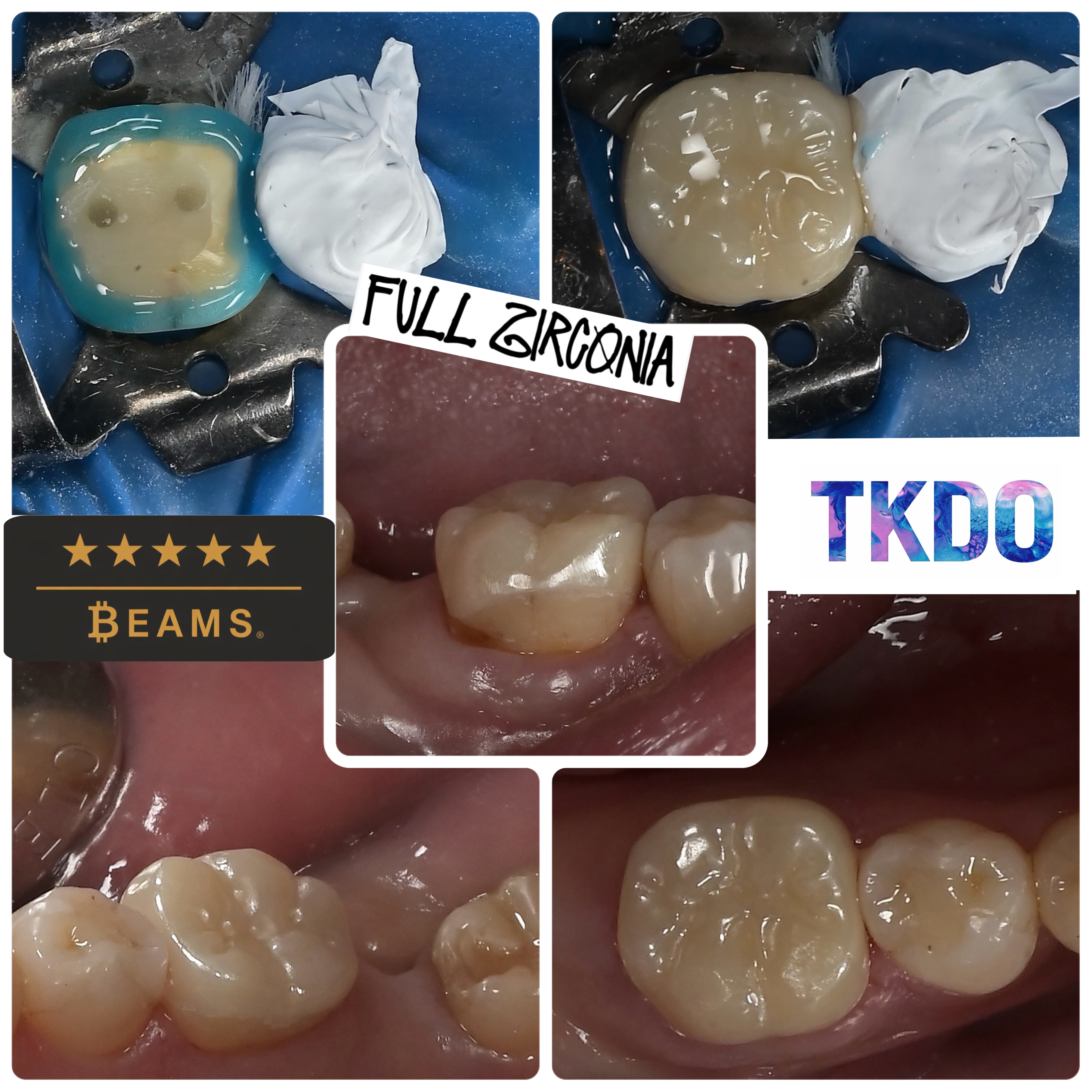 Full Zirconia Crown