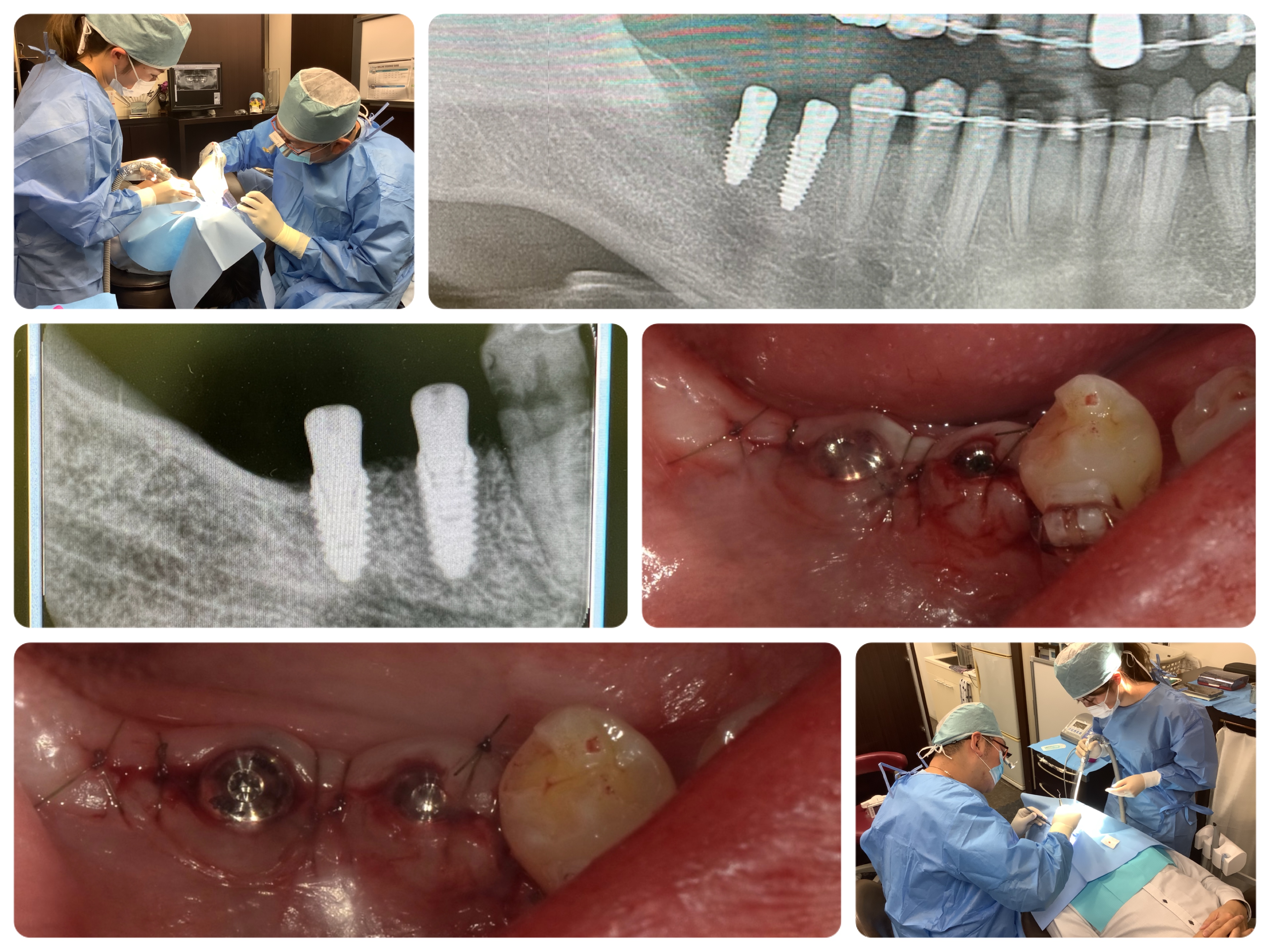患者さんに優しいインプラントオペ