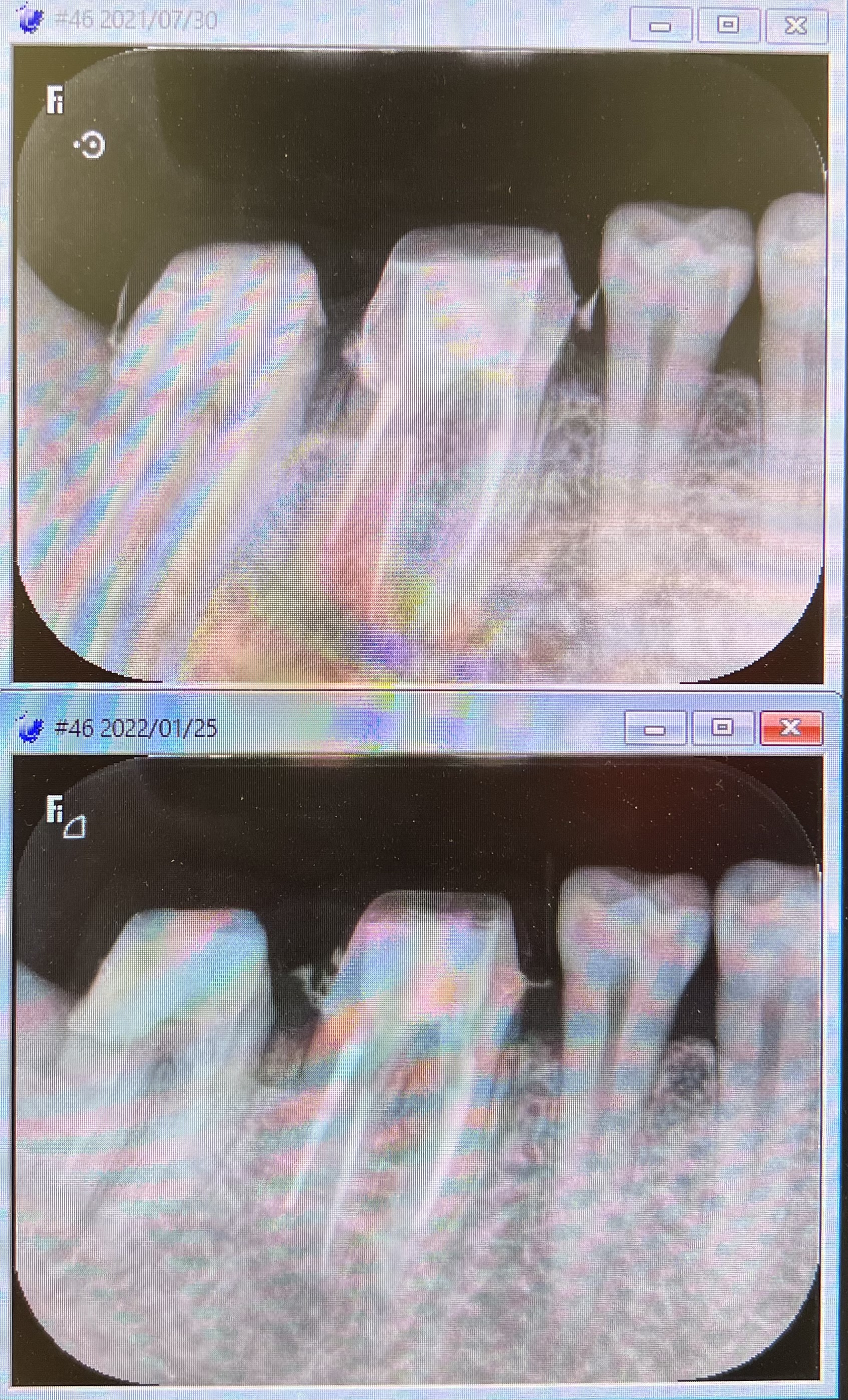レーザー使う歯周病手術