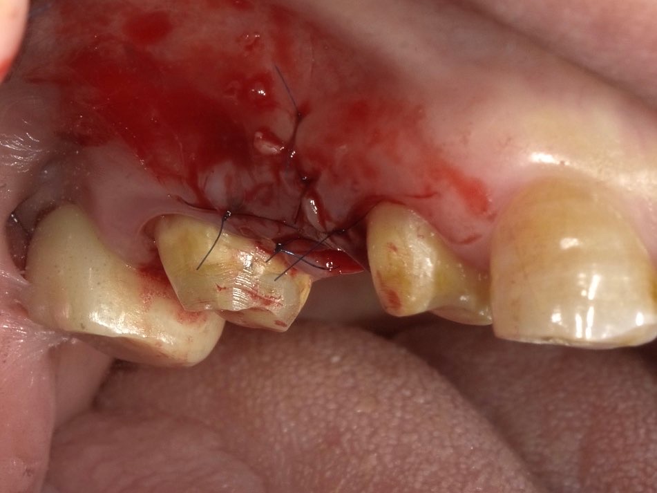 APF 歯肉根尖側移動術