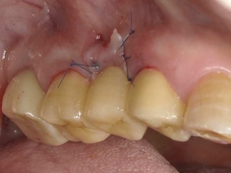 APF 歯肉根尖側移動術