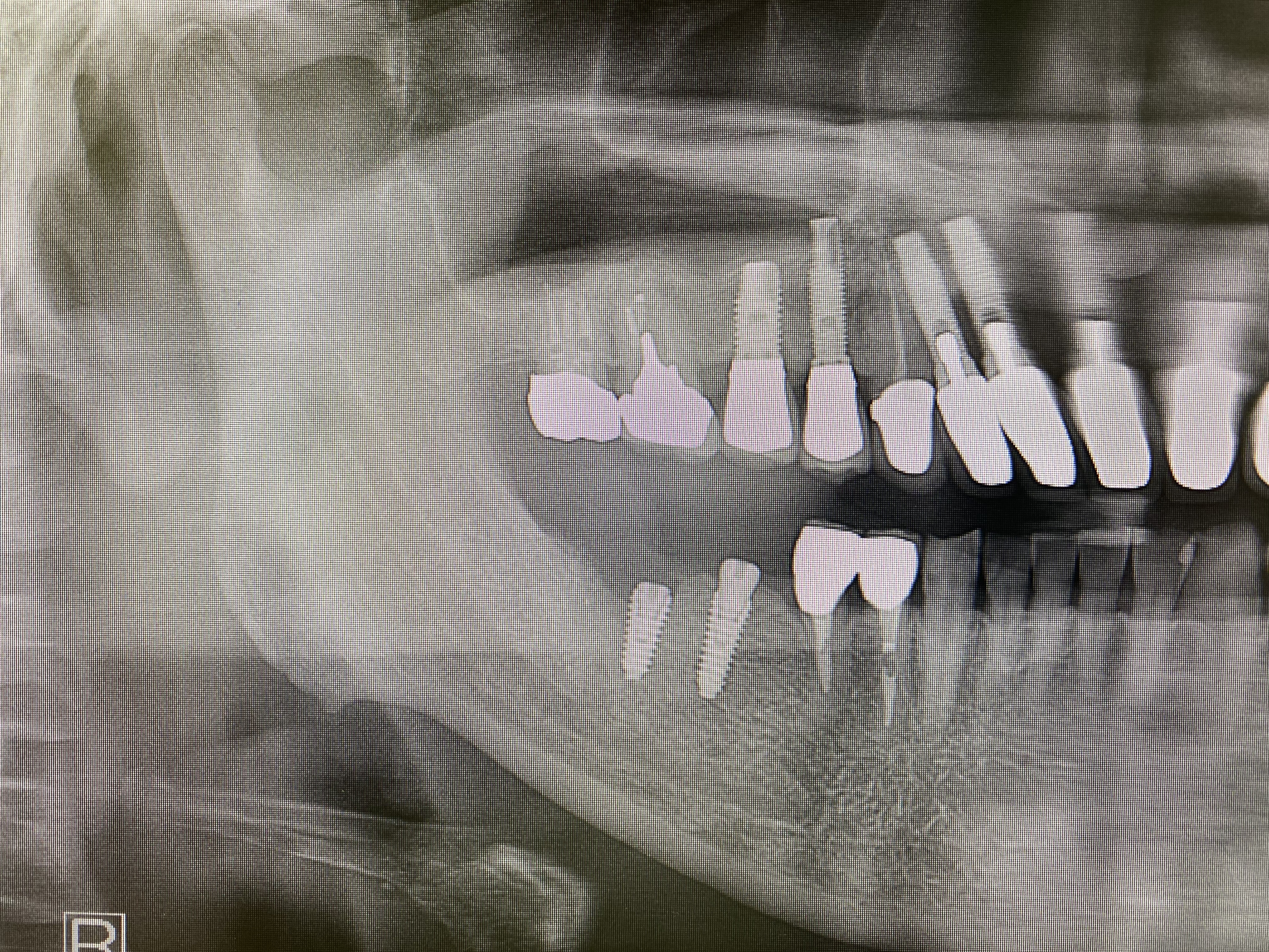 MEGAGEN Implant AnyRidge