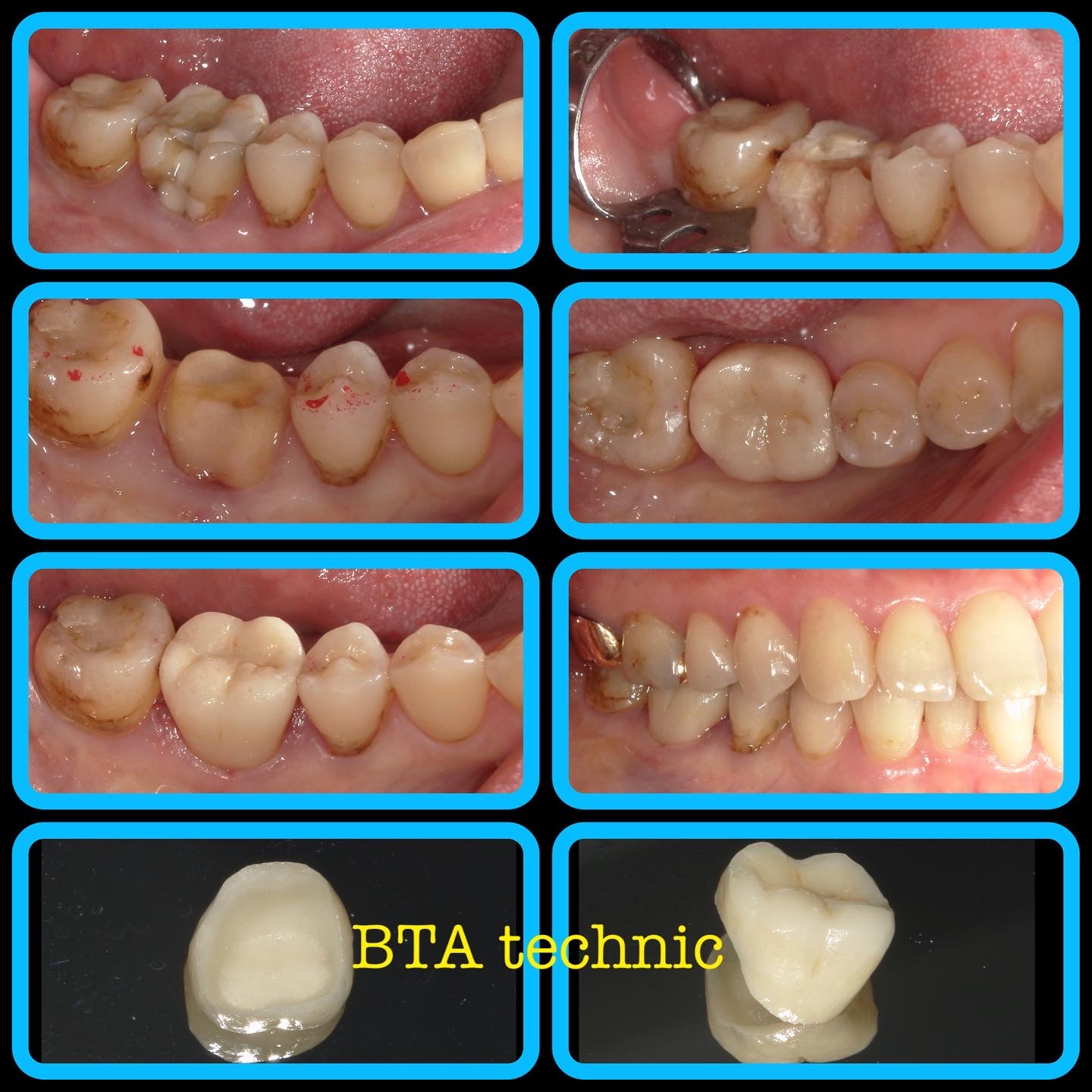 BTAで歯周外科回避