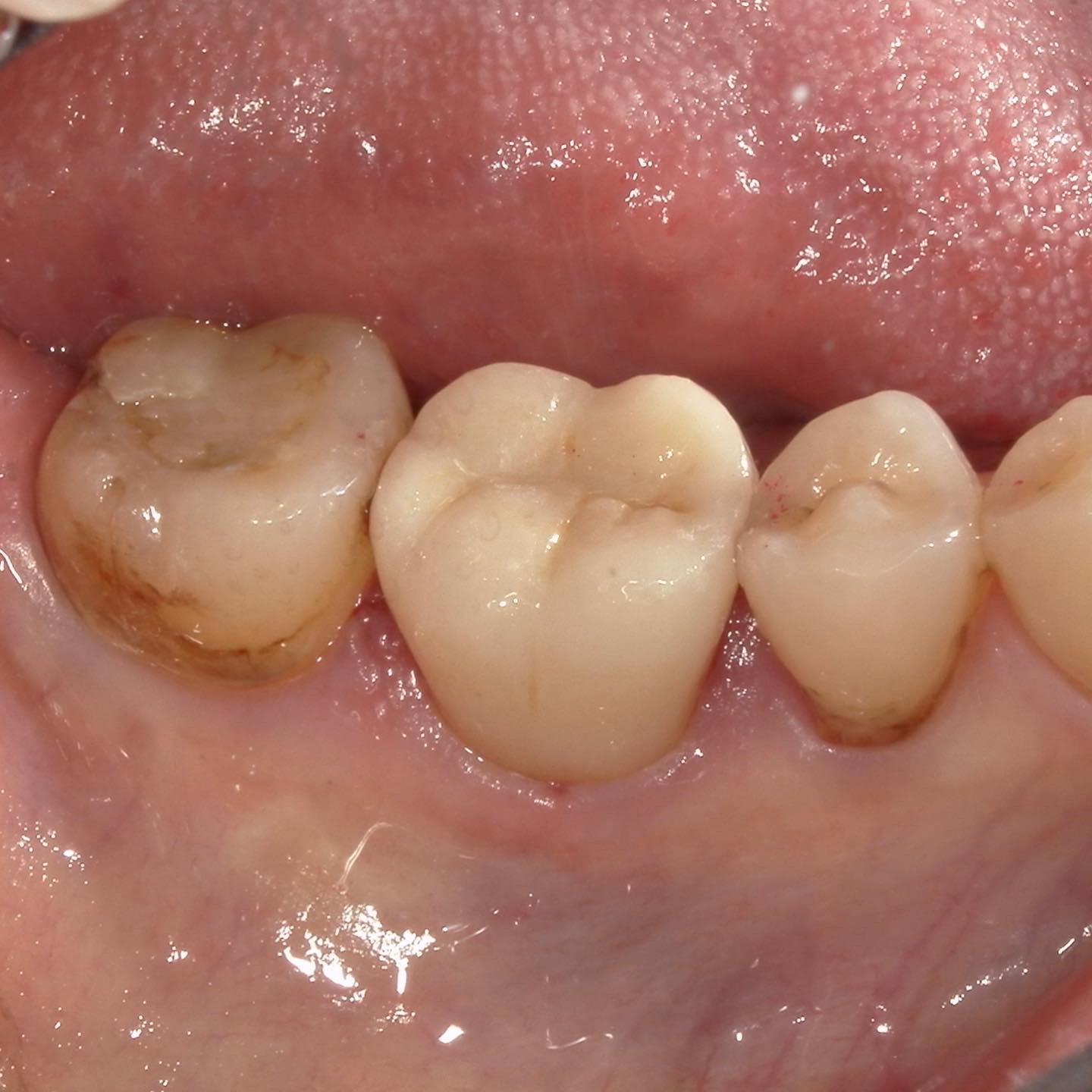 BTAで歯周外科回避