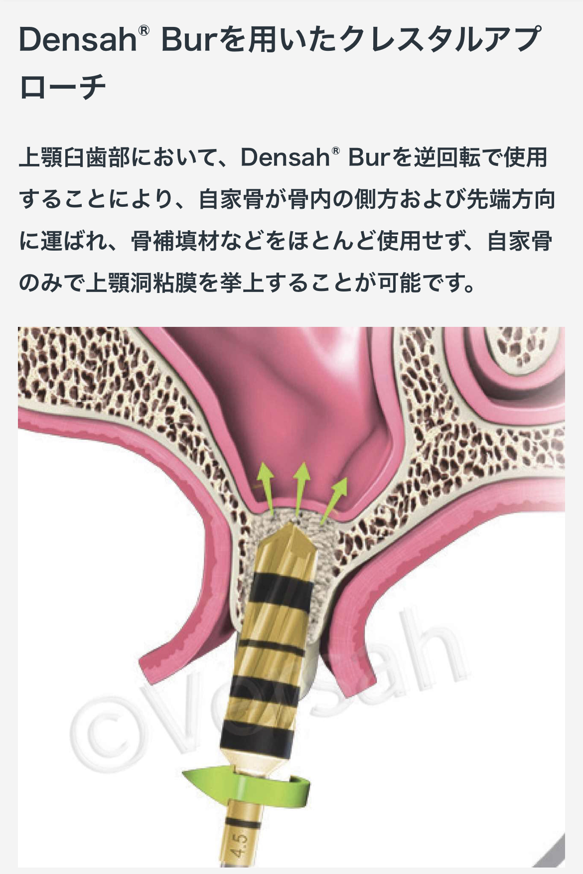 インプラント裏技キット