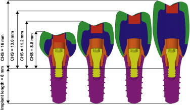 インプラントの上部構造の長さについて学び直しました