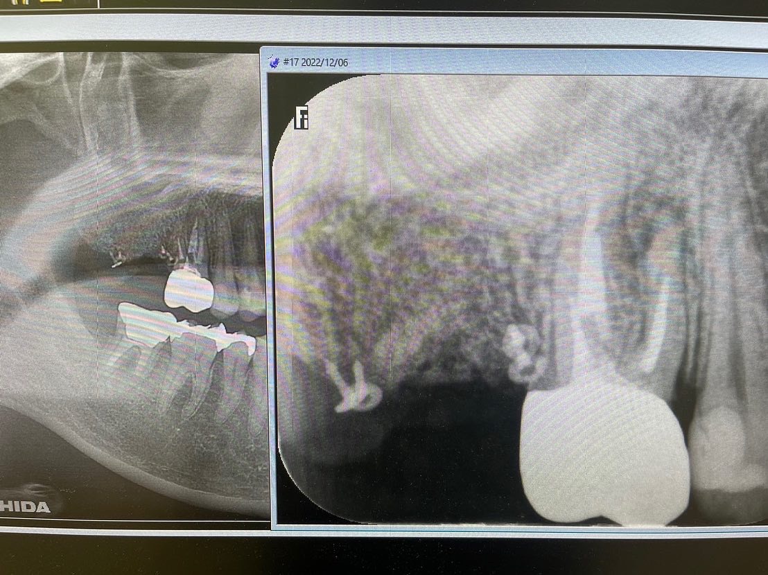 抜歯すると骨がなくなるので、骨保存し骨造成しました