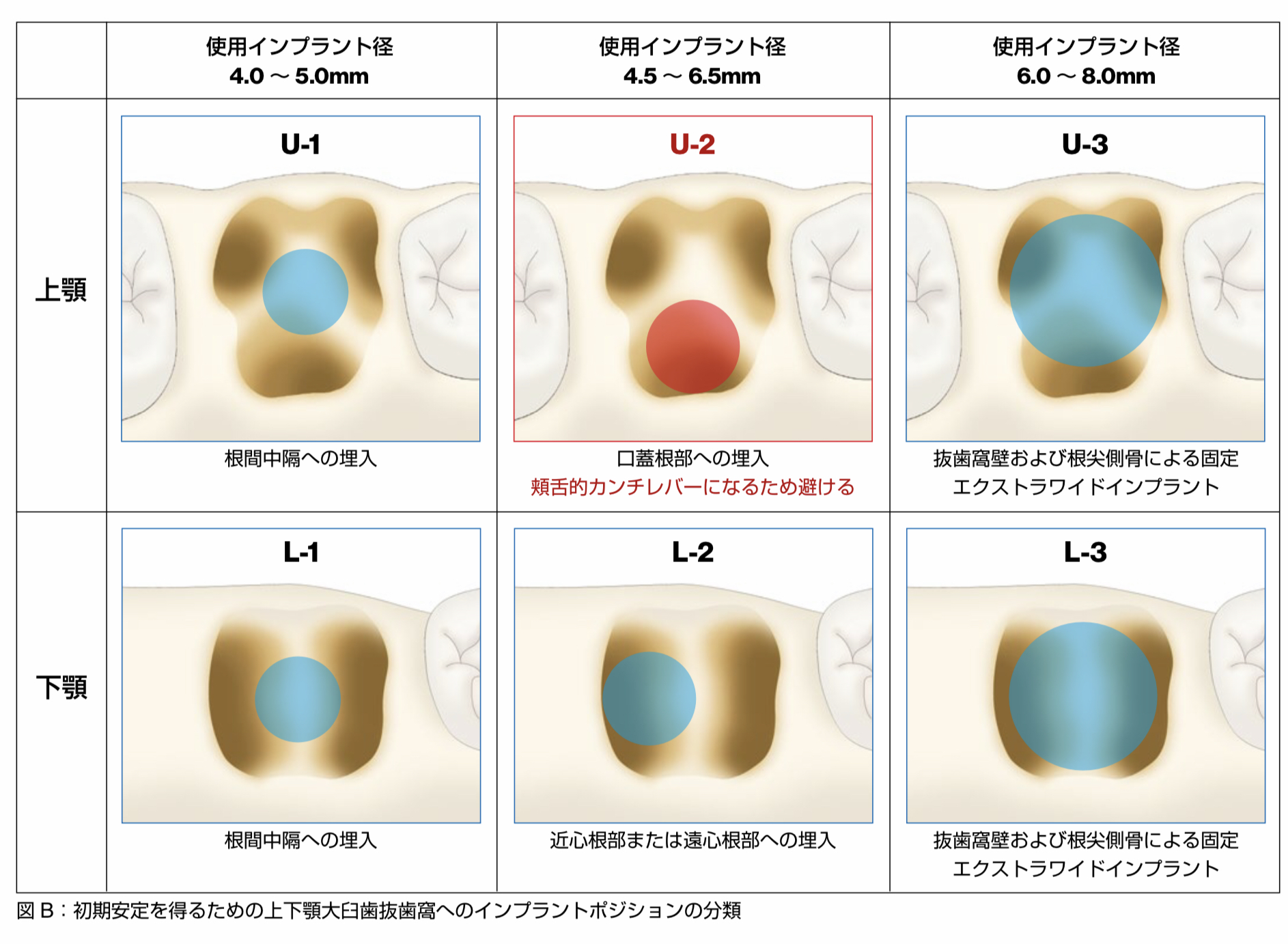 インプラント勉強