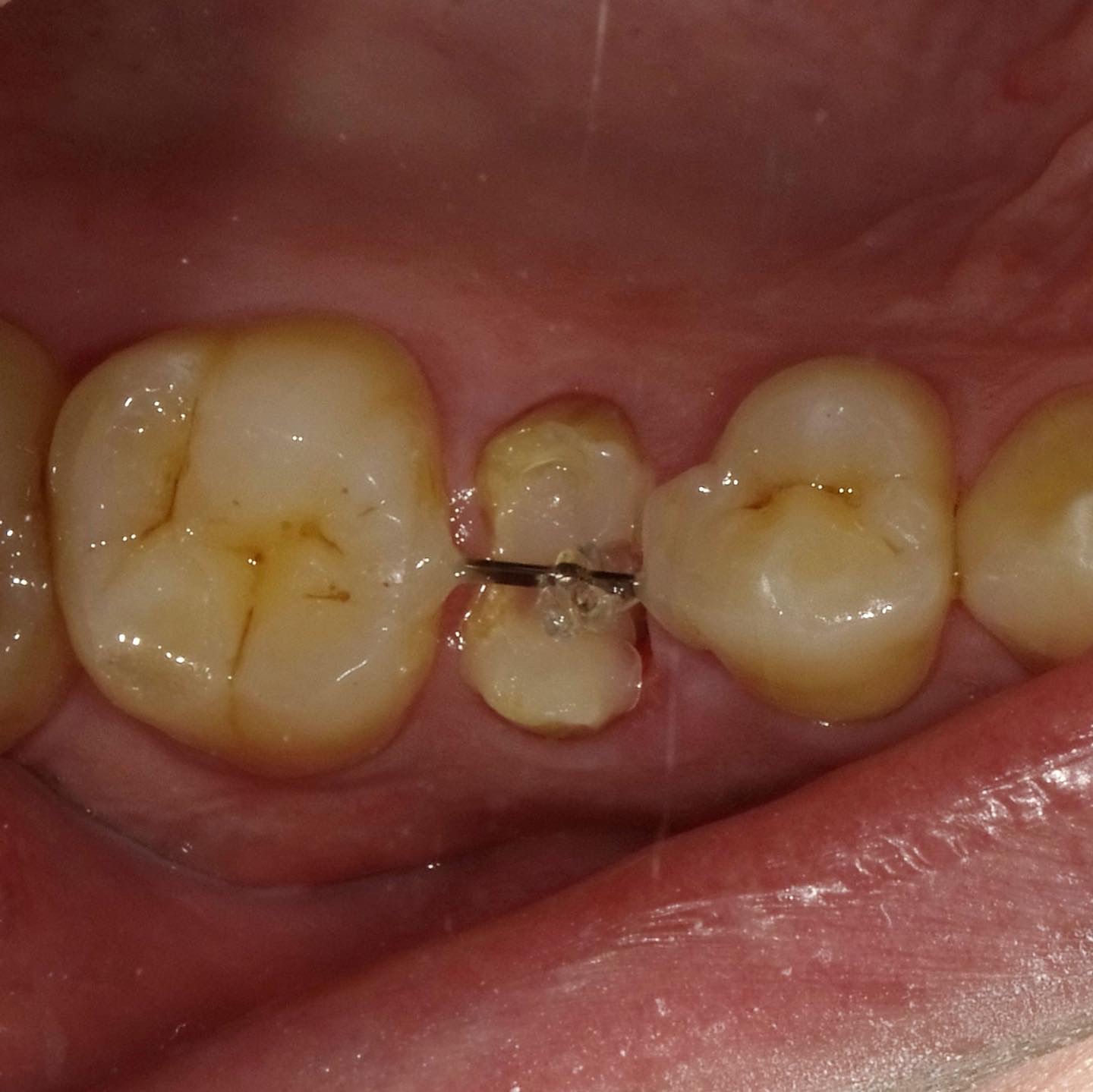 インプラントのため抜歯？いやいや、歯を引っ張り出せばまだ使える！