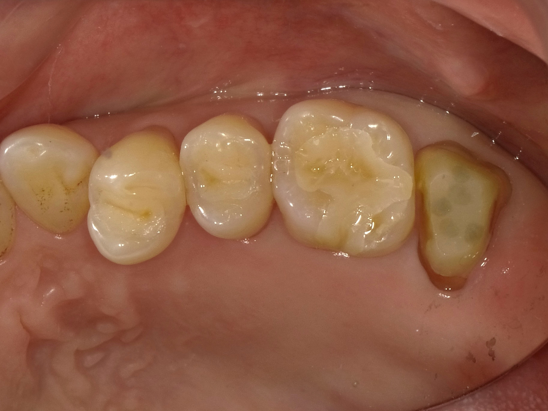 審美的かつ中長期的に長持ちする歯科医療