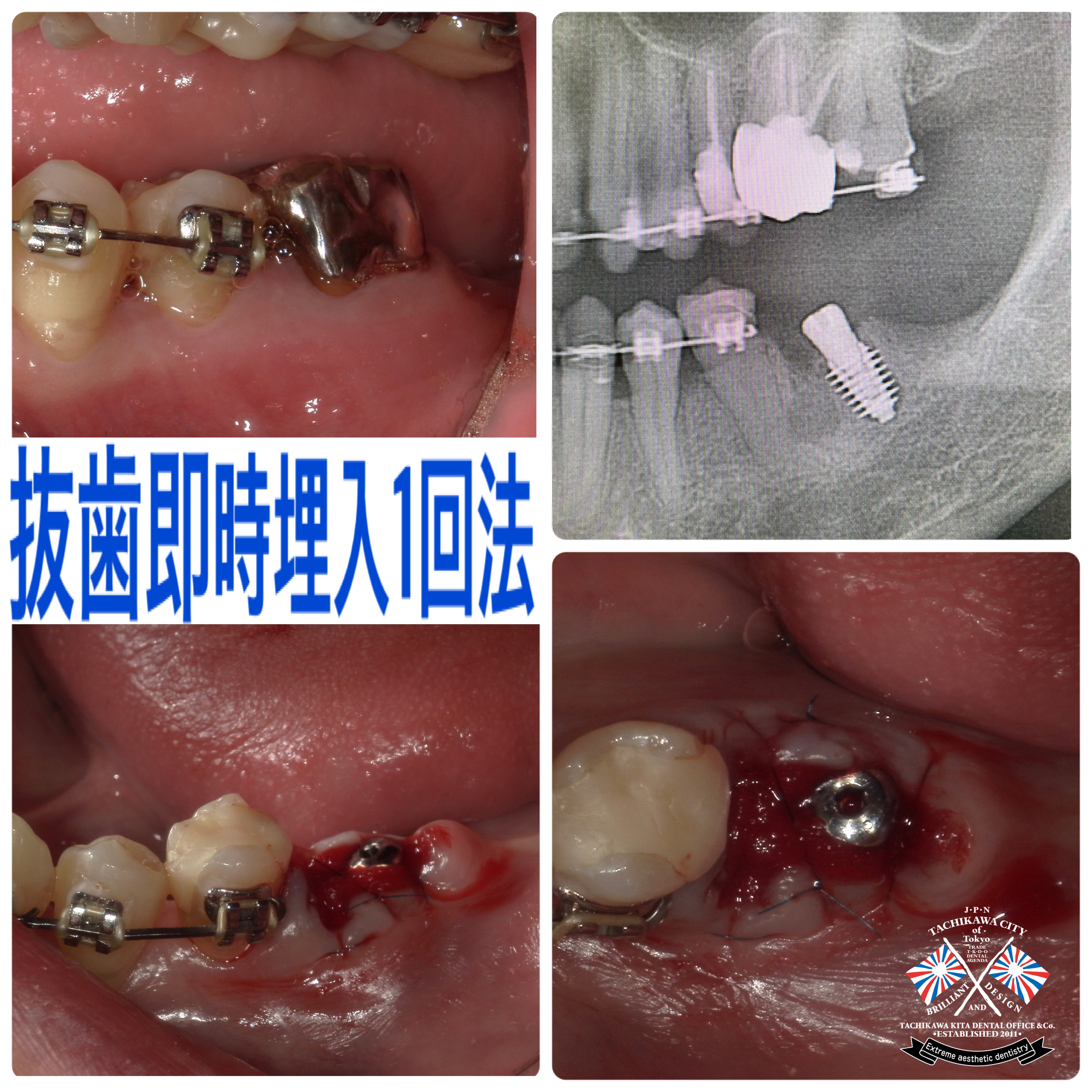 抜歯即時埋入インプラント