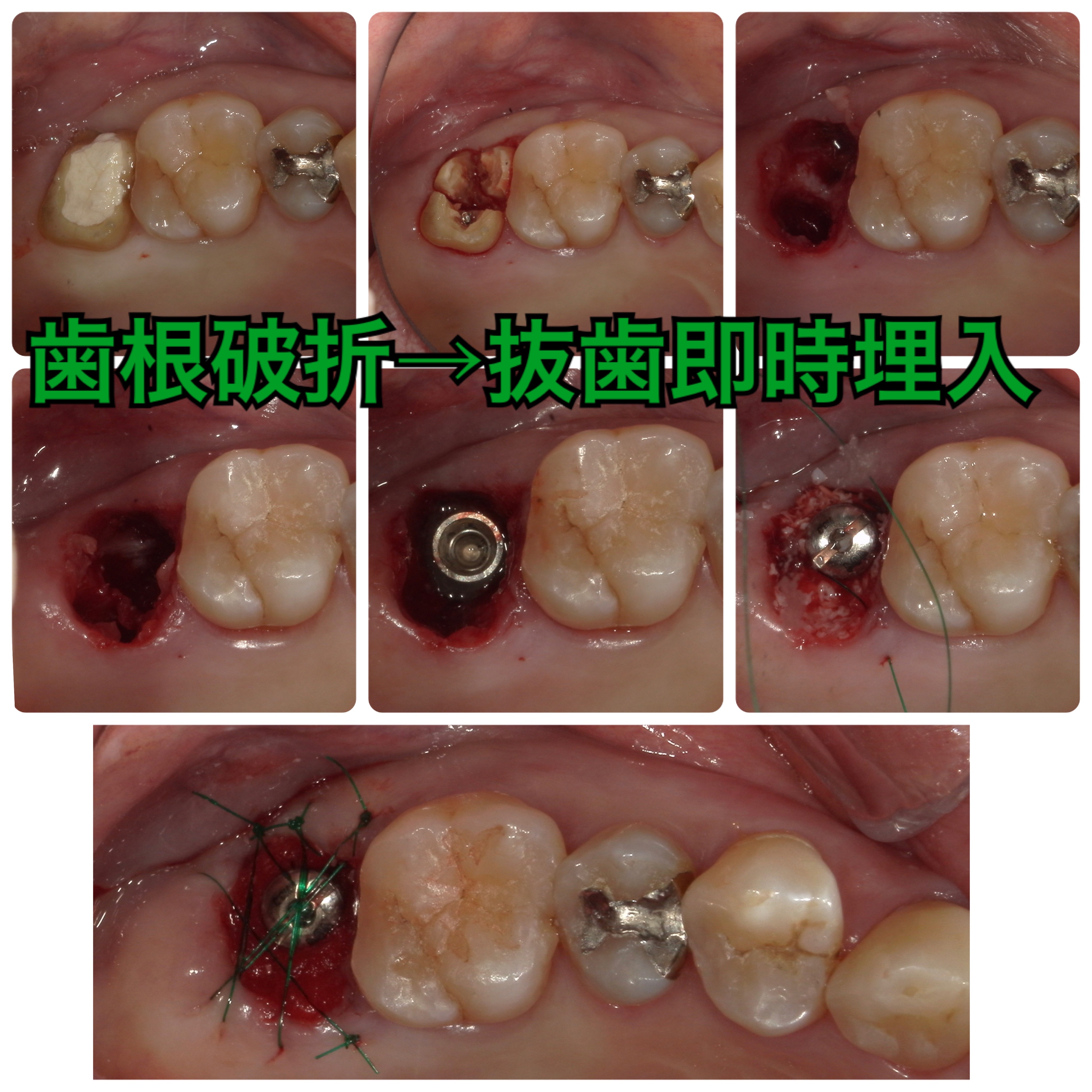 歯根破折を即日インプラント埋入