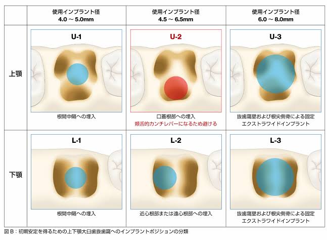 インプラントセミナー後の復習