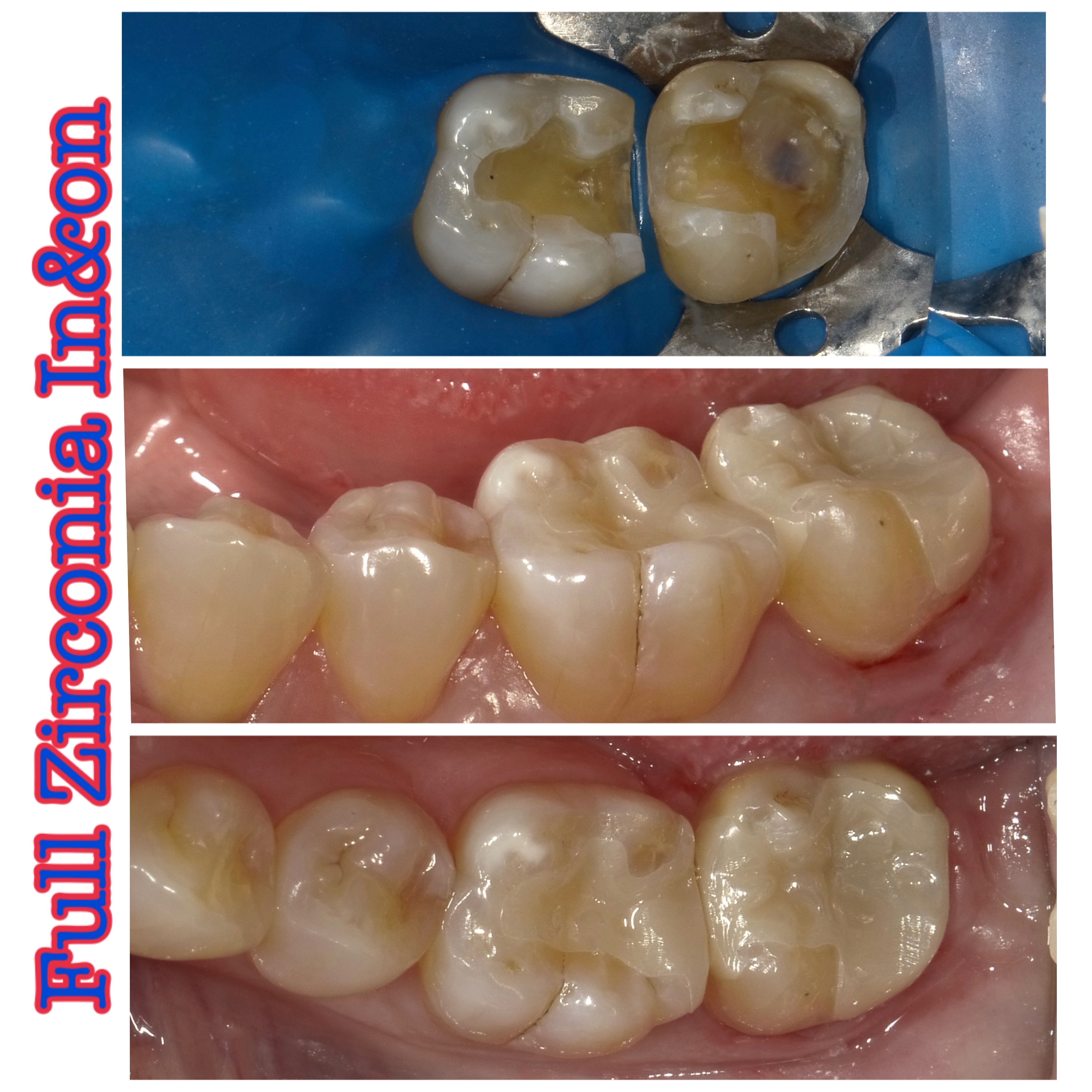 Full Zirconia In