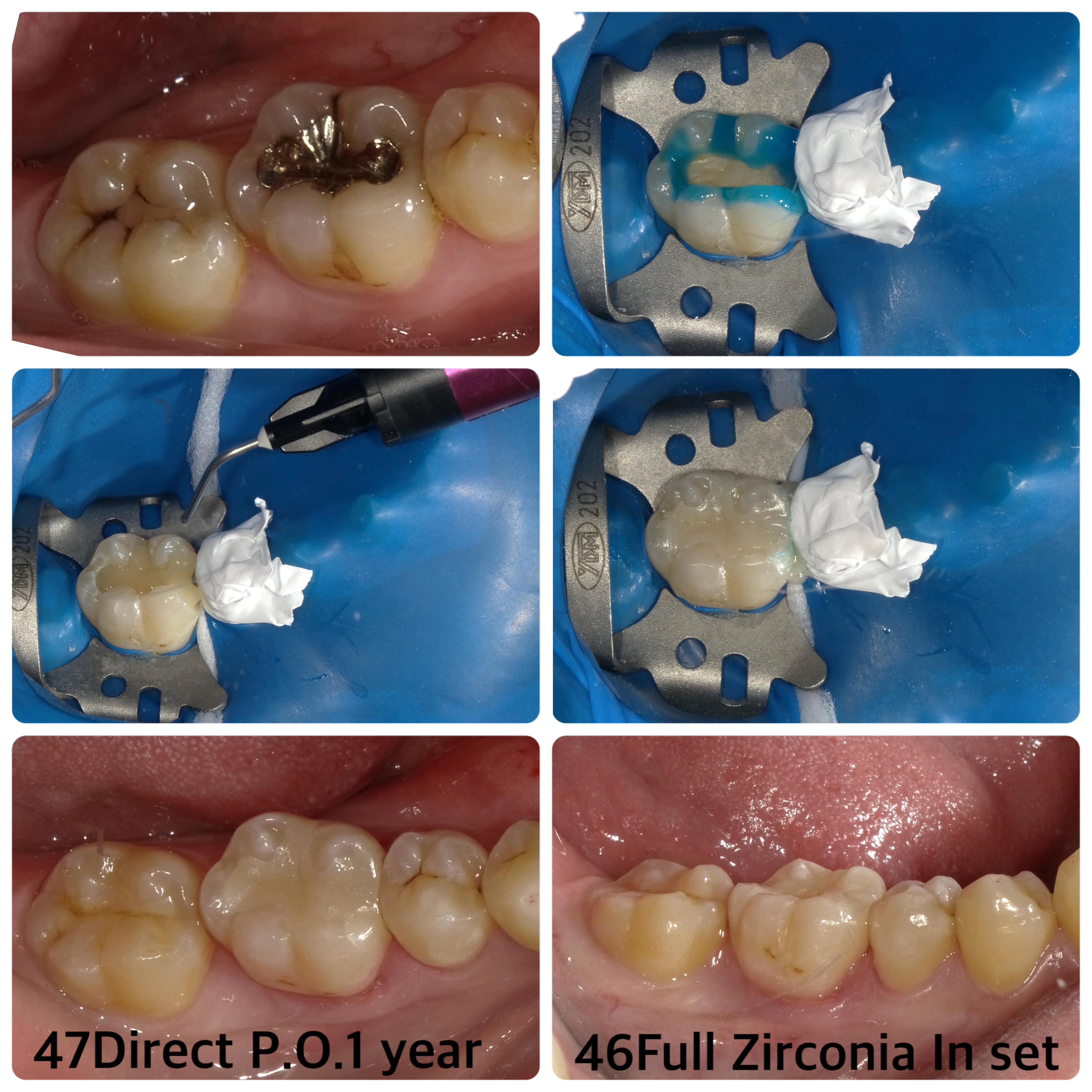 ダイレクトボンディングとFull Zirconia In