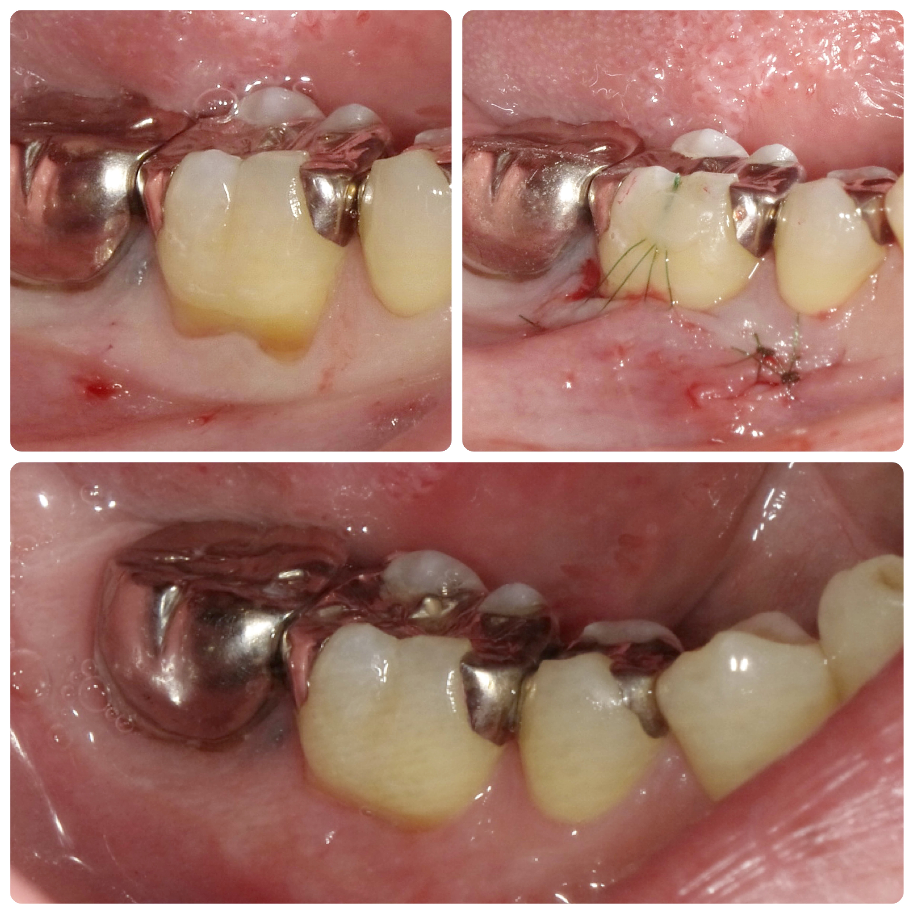 VISTAテクニック　歯肉退縮を引き上げる手術