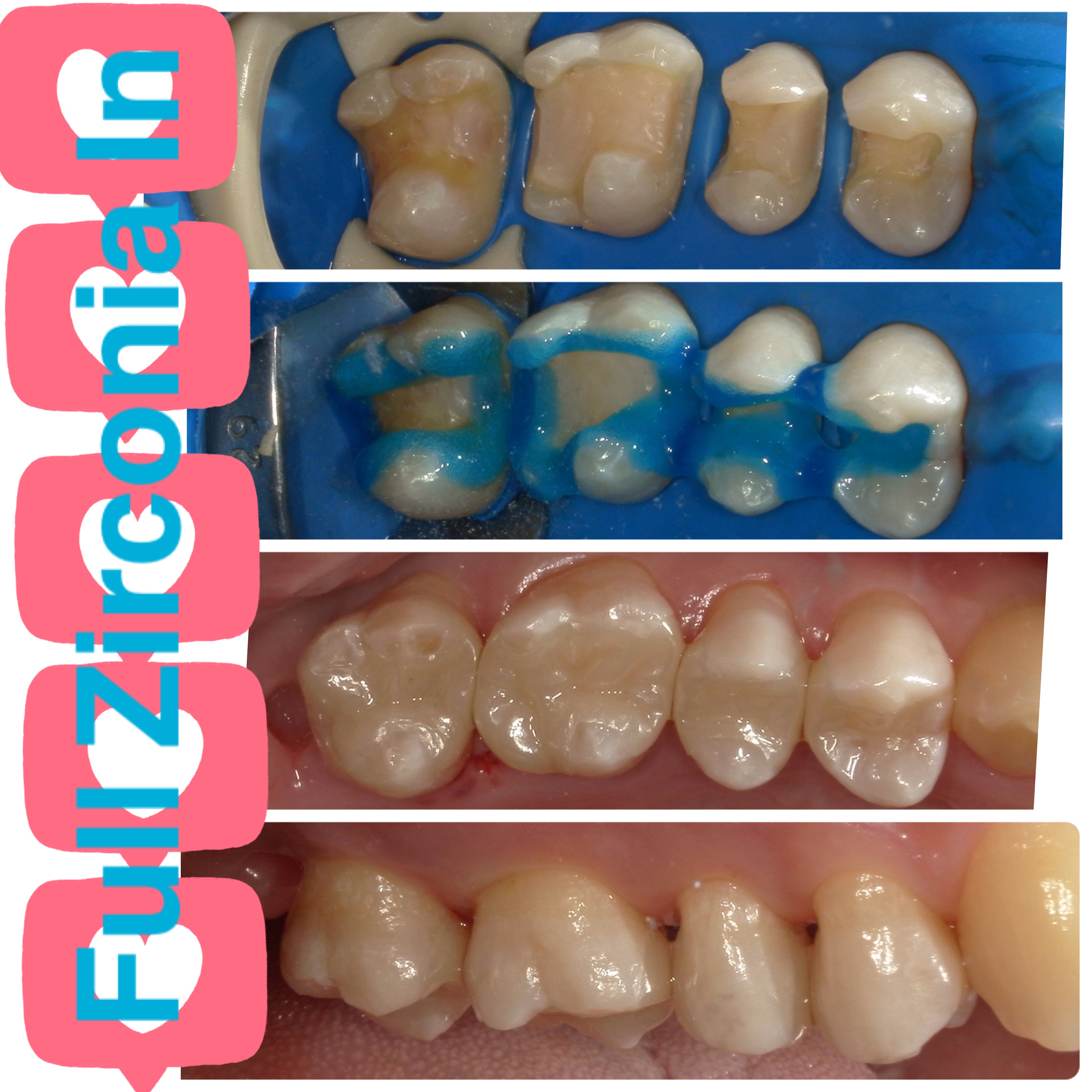 審美的かつ最強の素材＝Full Zirconia 
