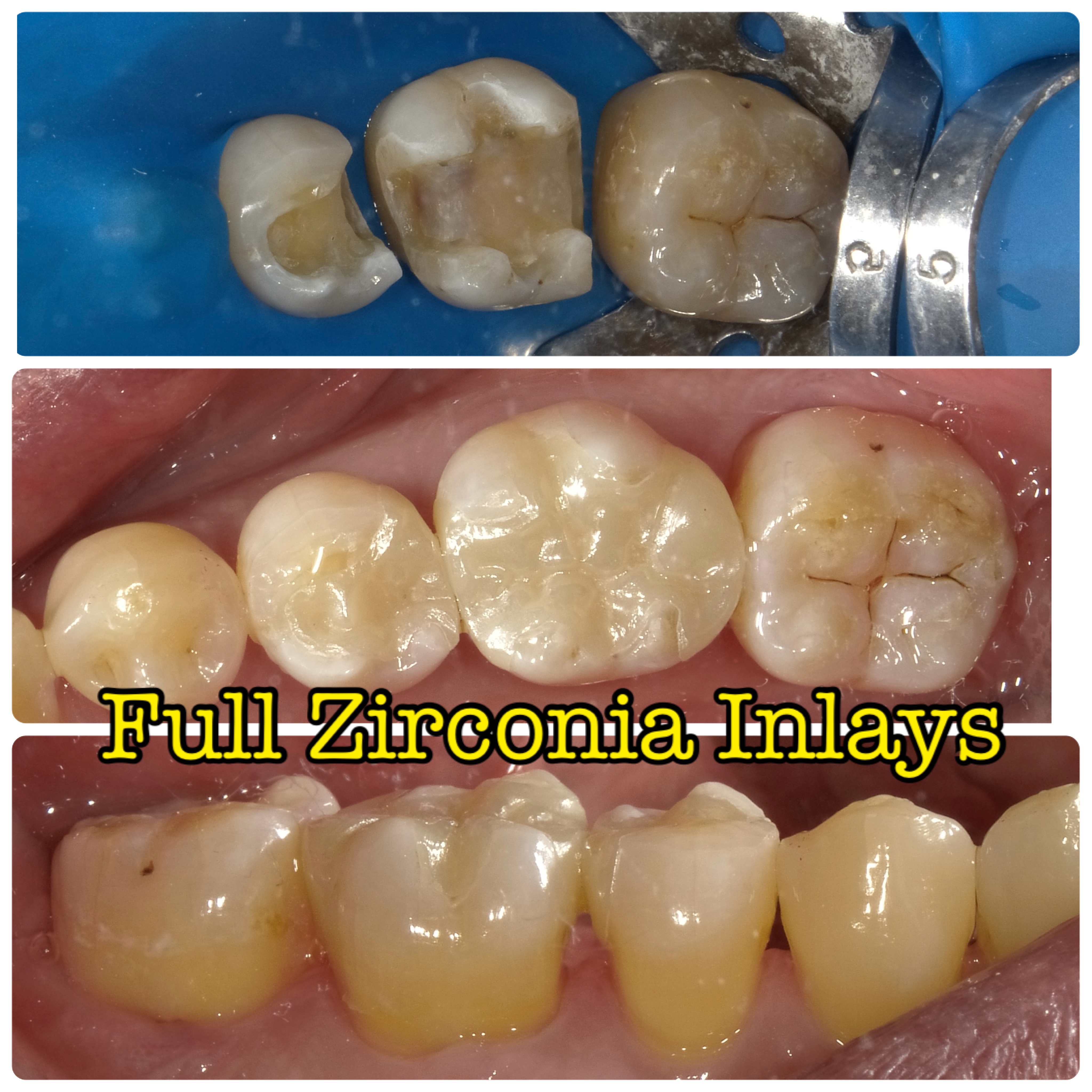 Full Zirconia In