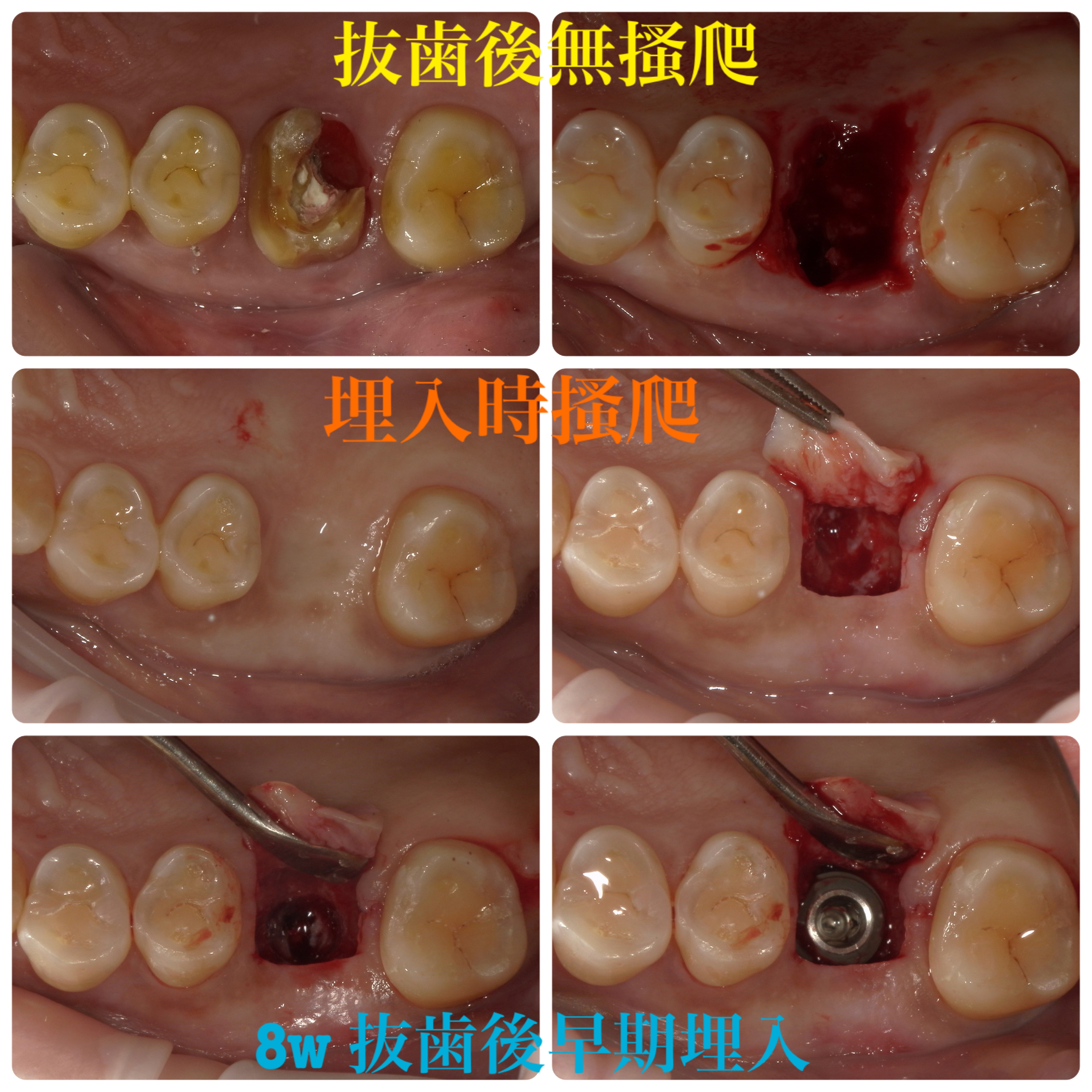 抜歯早期埋入