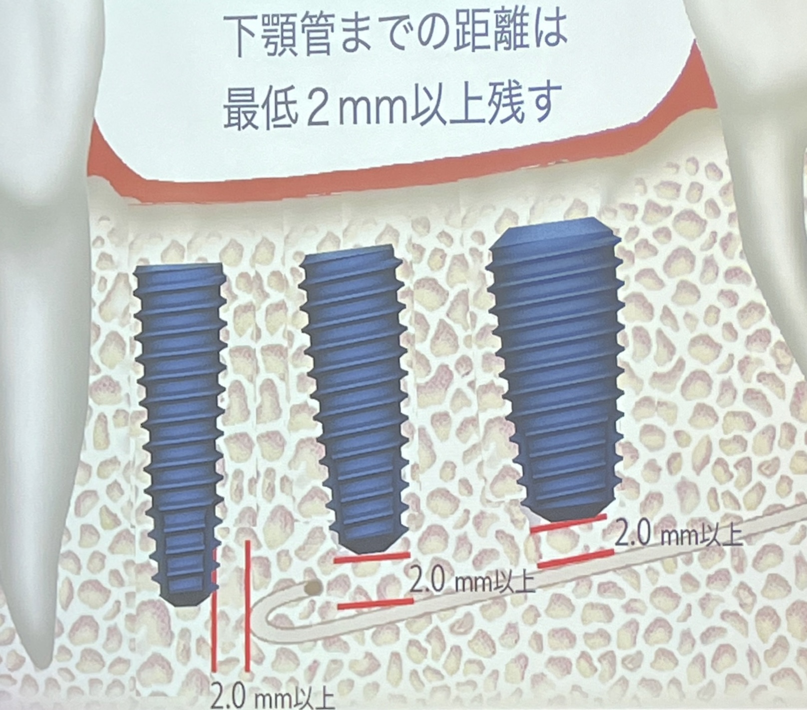 難しい下顎臼歯部インプラント