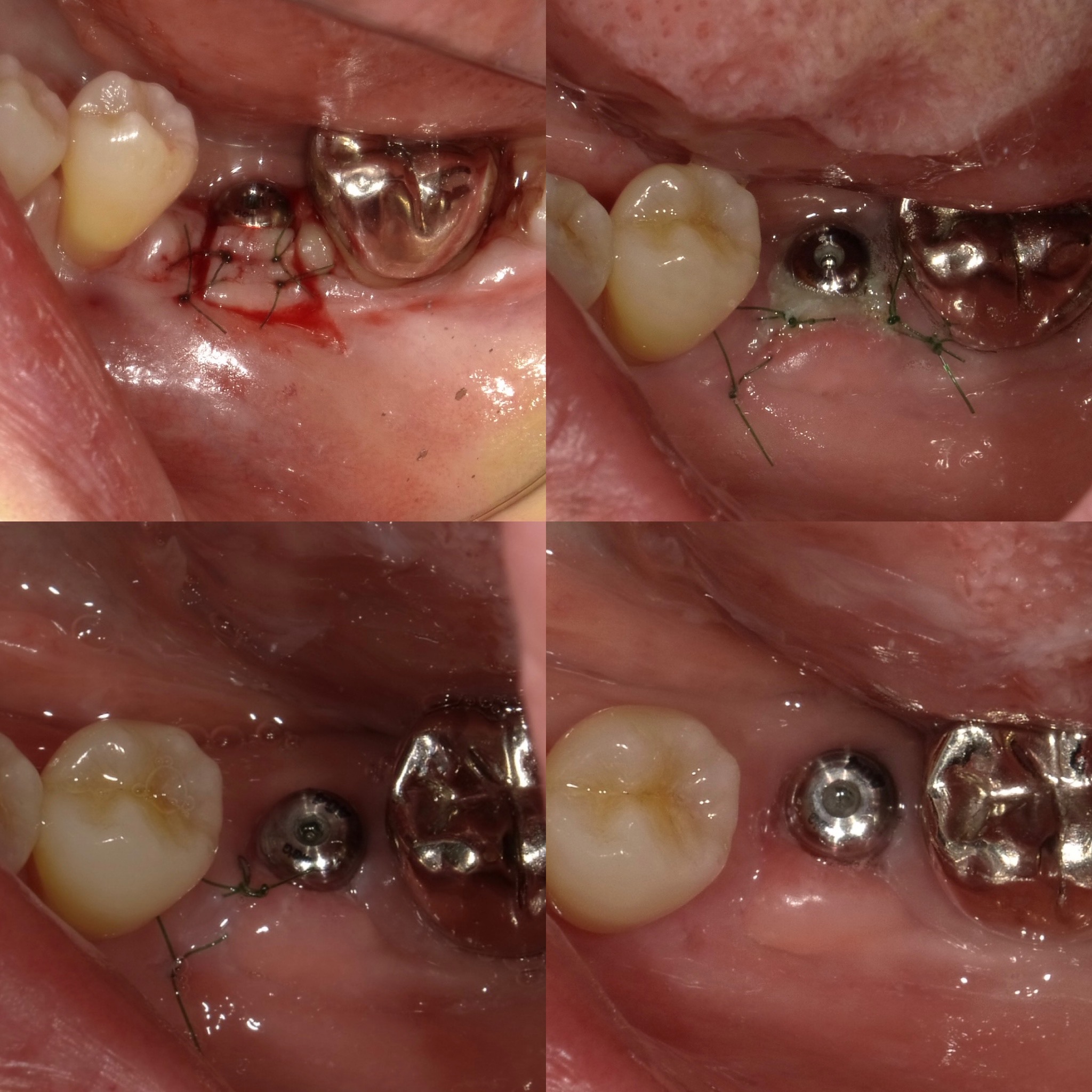 MEGAGEN Implant AnyRidge 2次オペ・APF