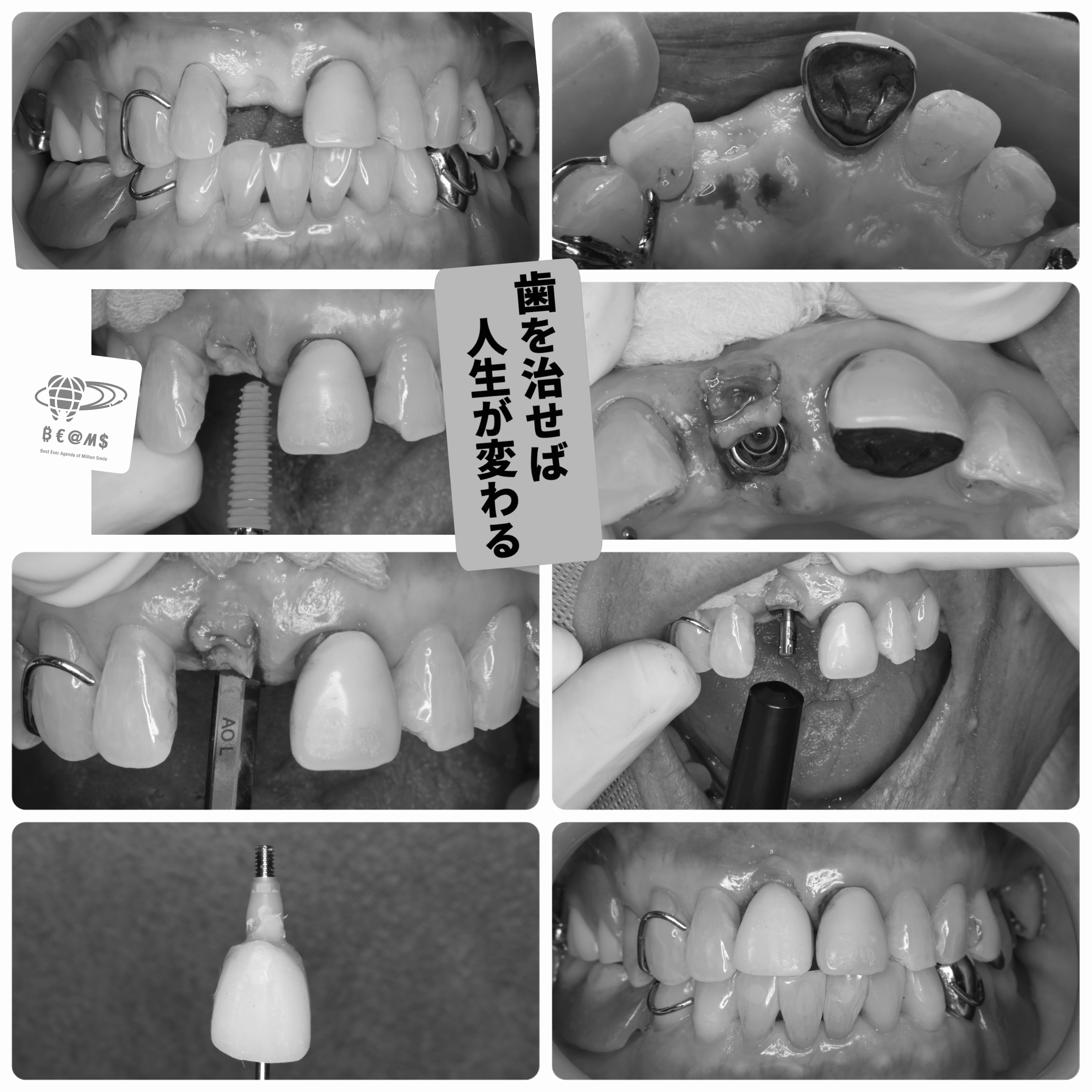出張インプラントオペ