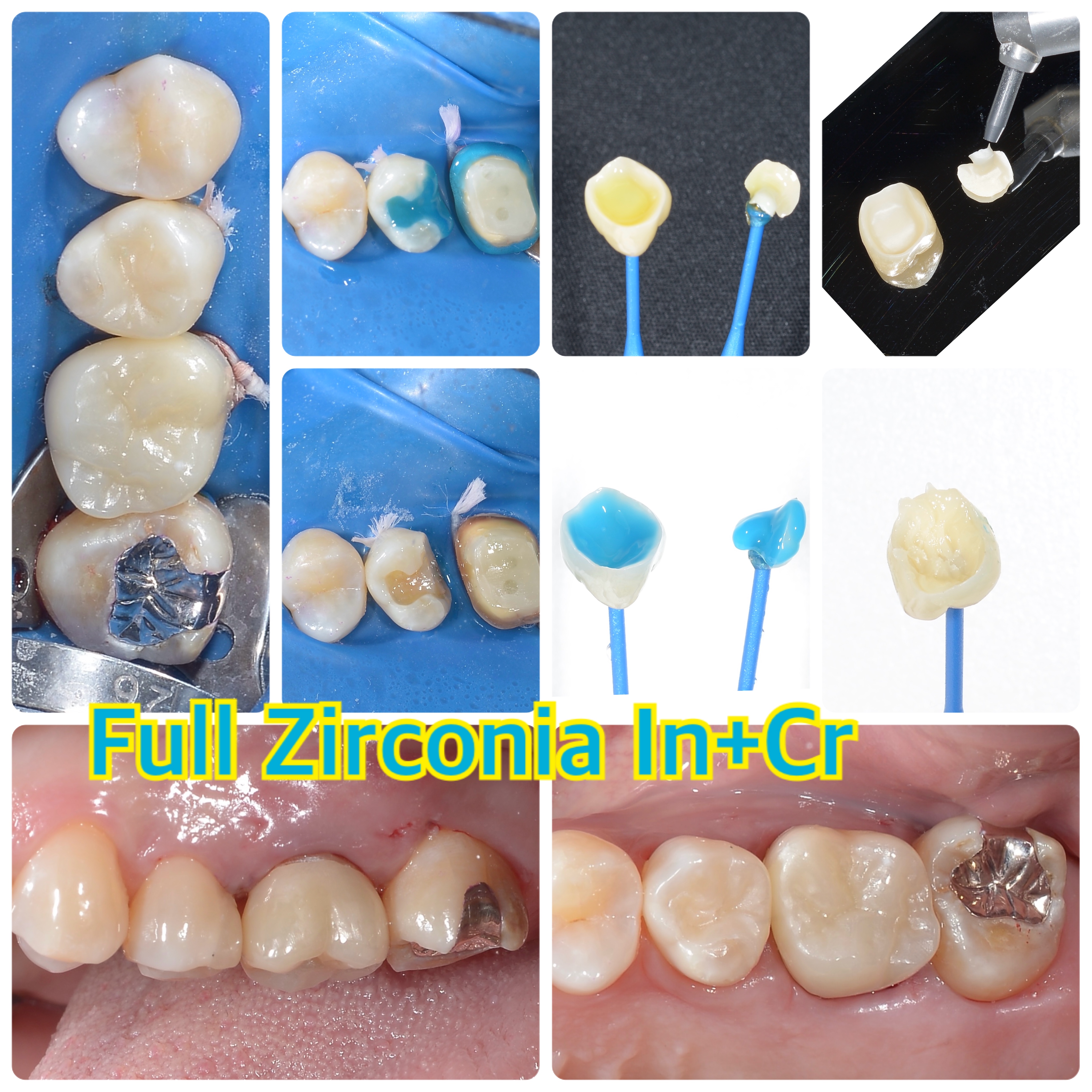 Full Zirconia