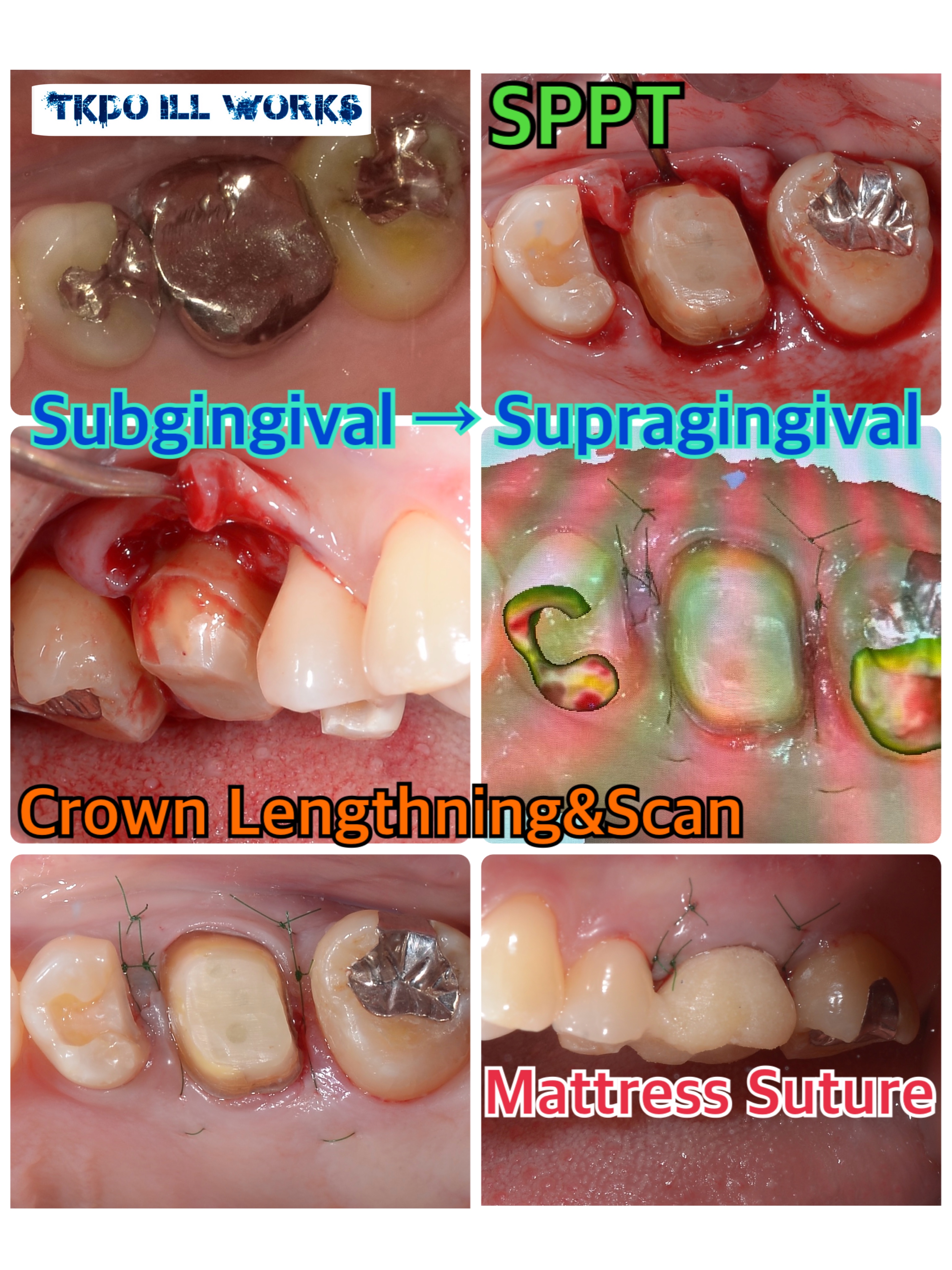 Full Zirconia