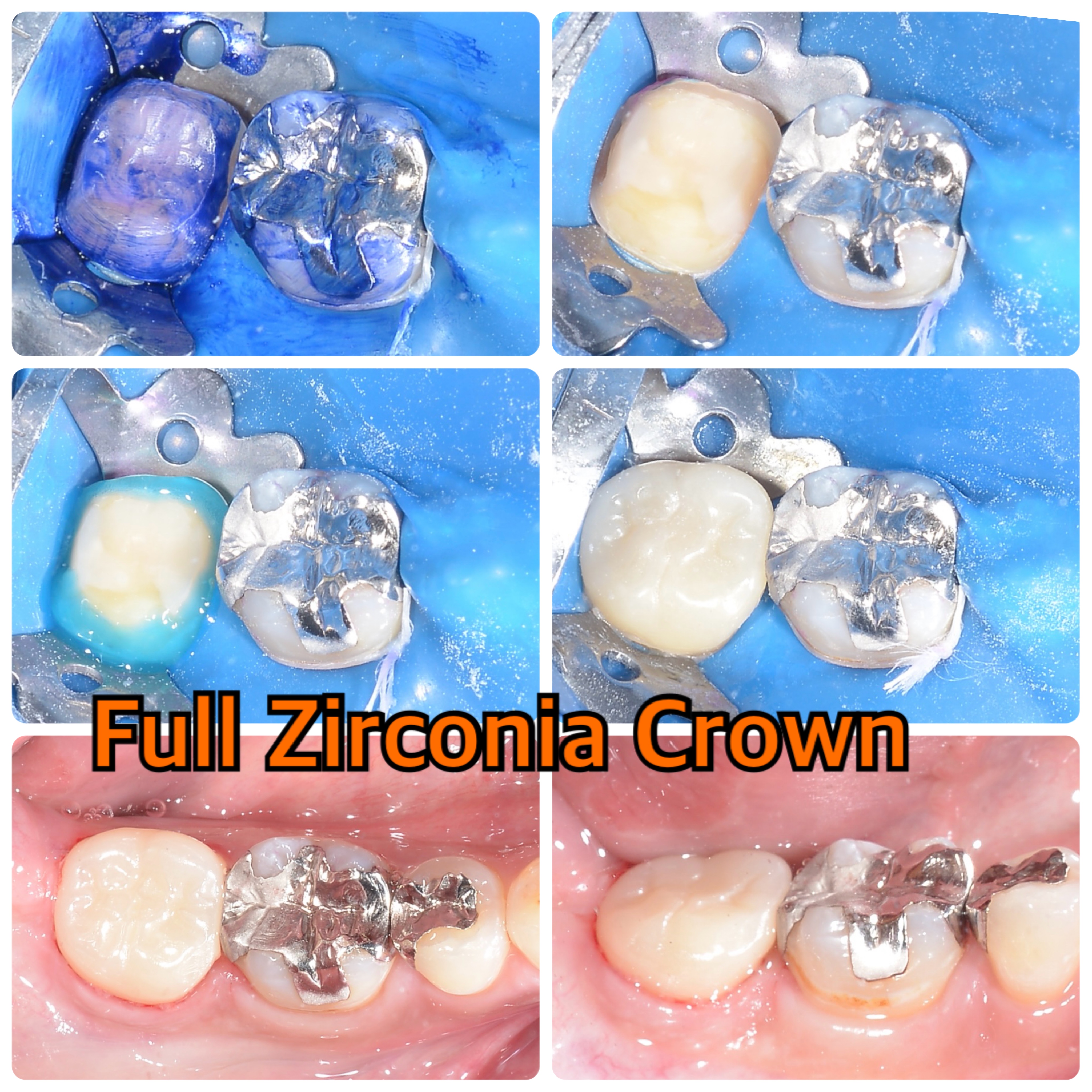 Full Zirconia Crown