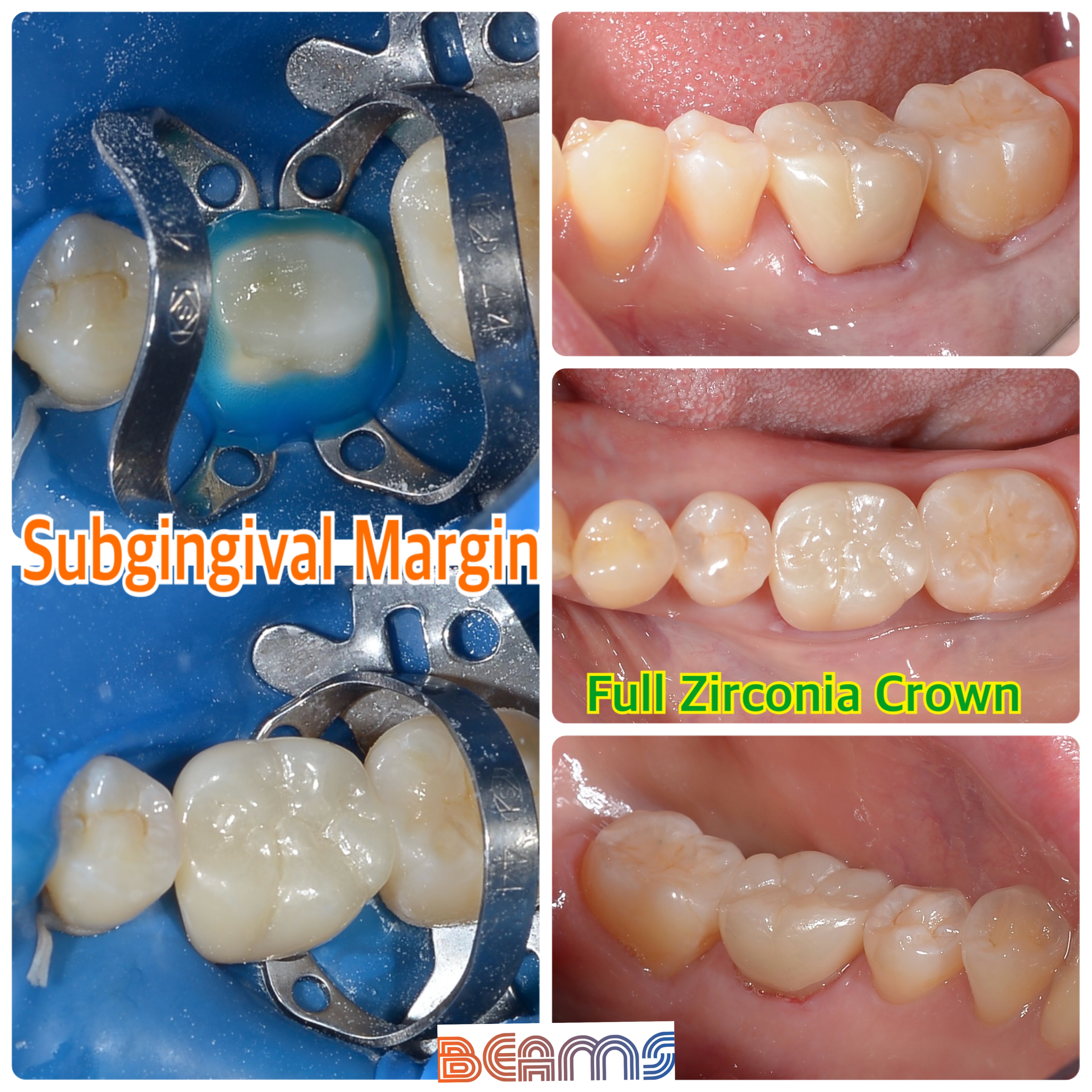 Full Zirconia Crown