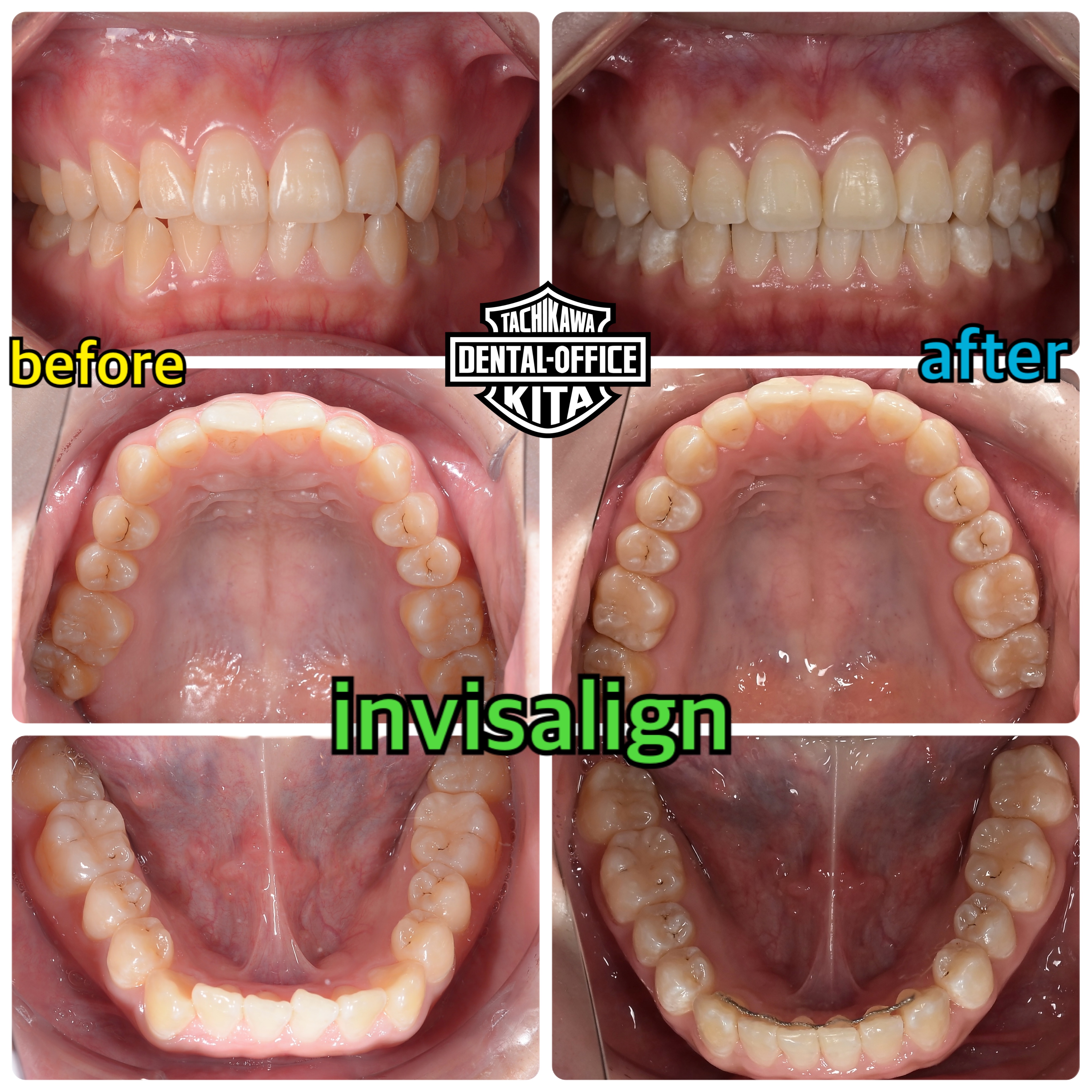 invisalign