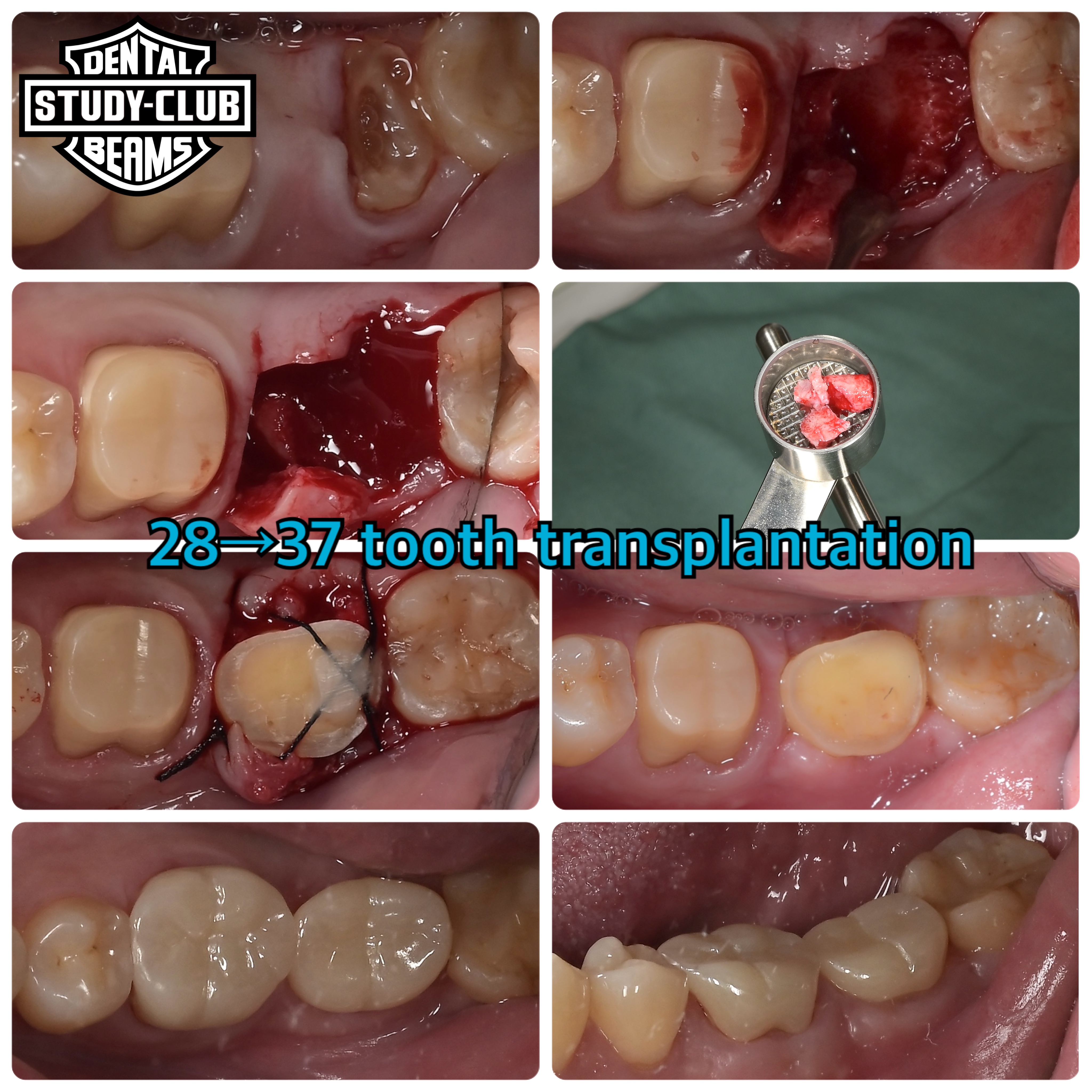 移植できる人、出来ない人