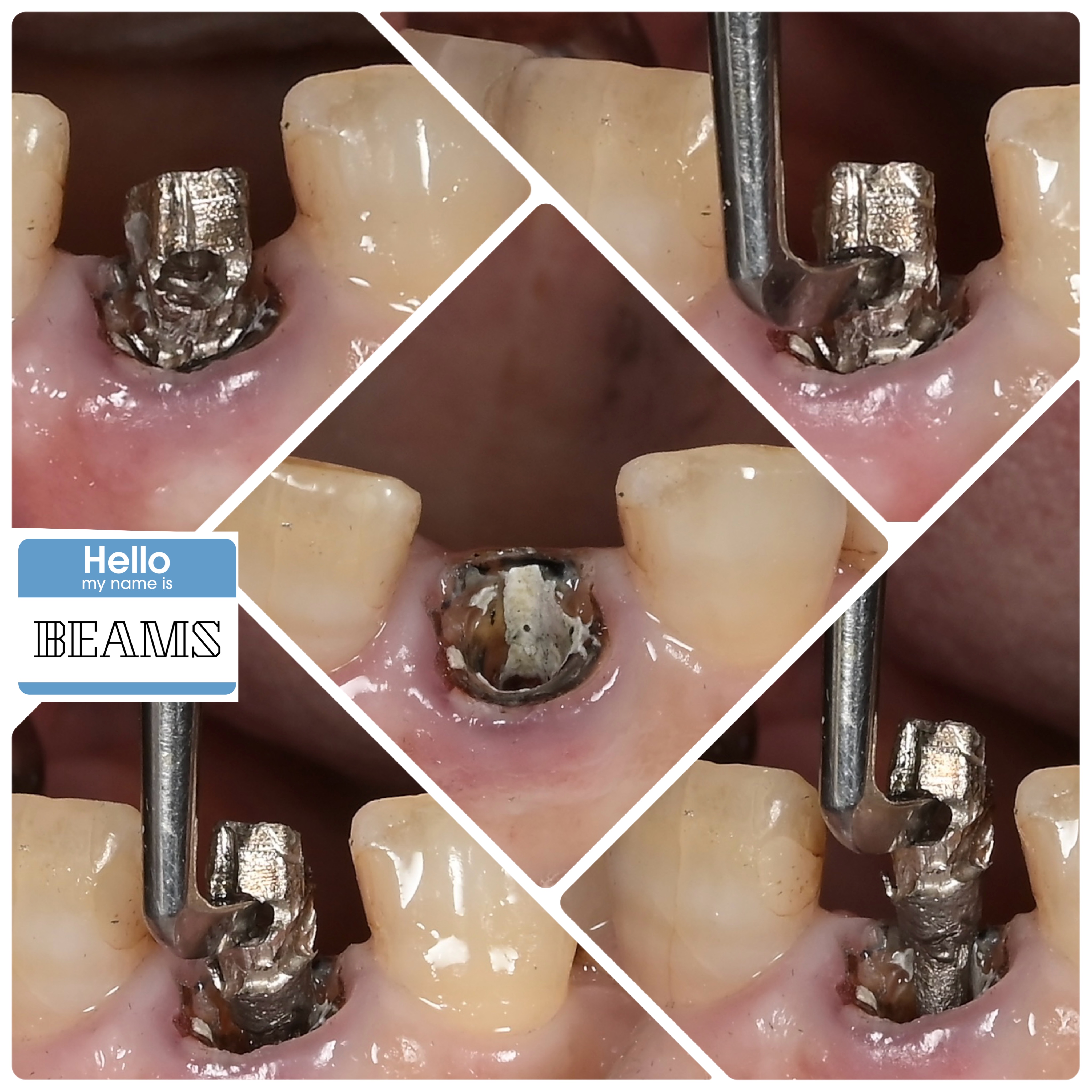 メタルコア除去