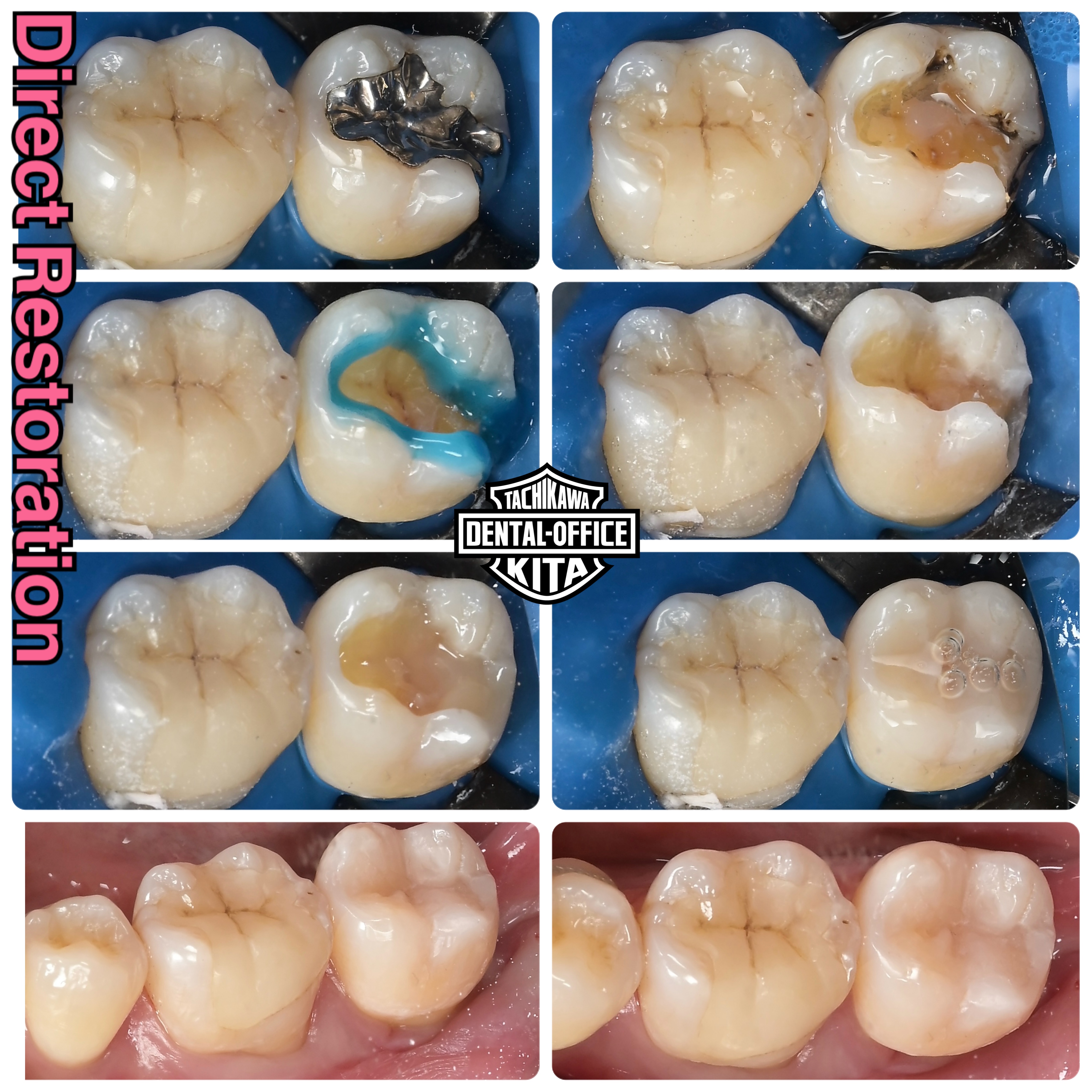 得意な結合組織移植とダイレクトボンディング
