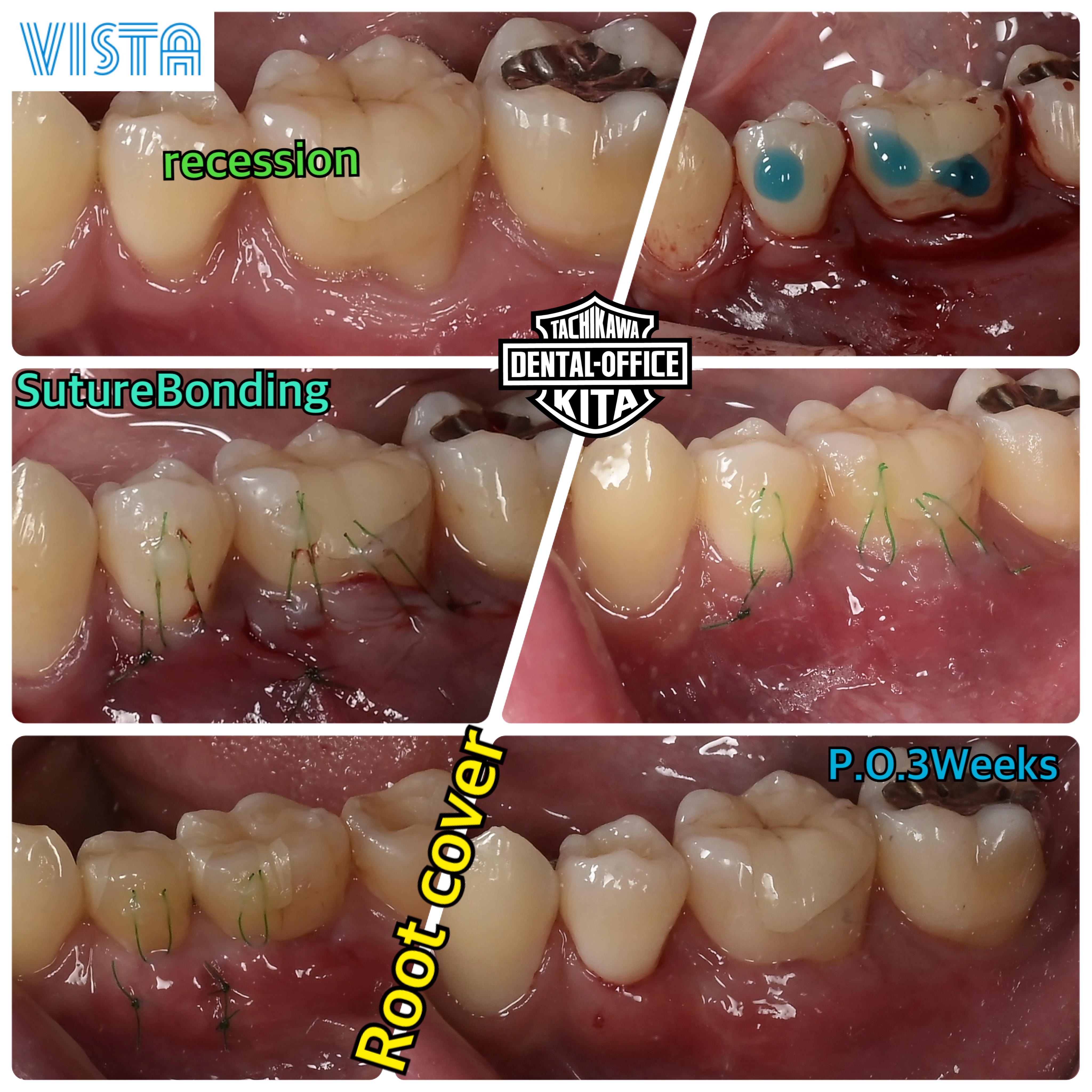 得意な結合組織移植とダイレクトボンディング