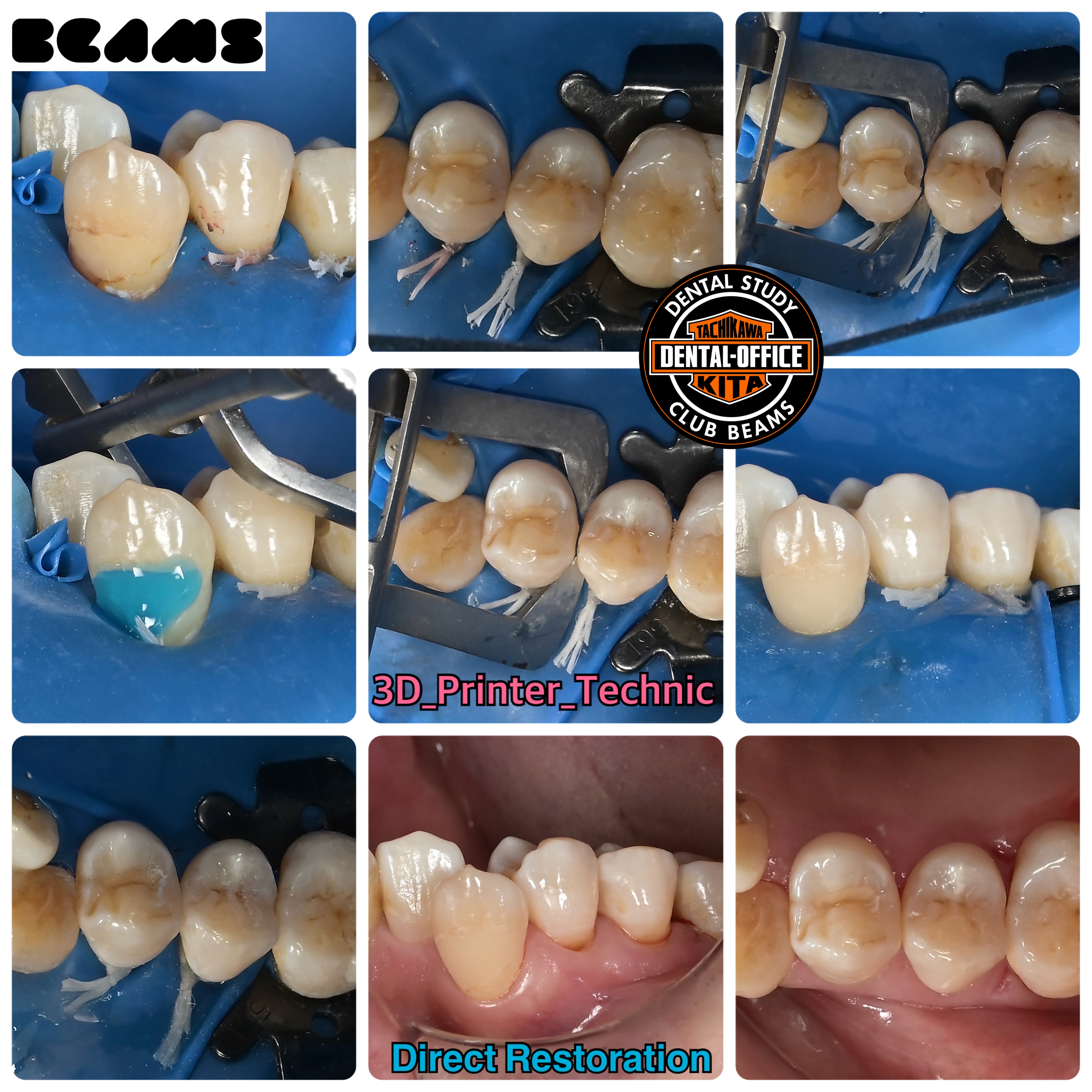 色んなダイレクトボンディング