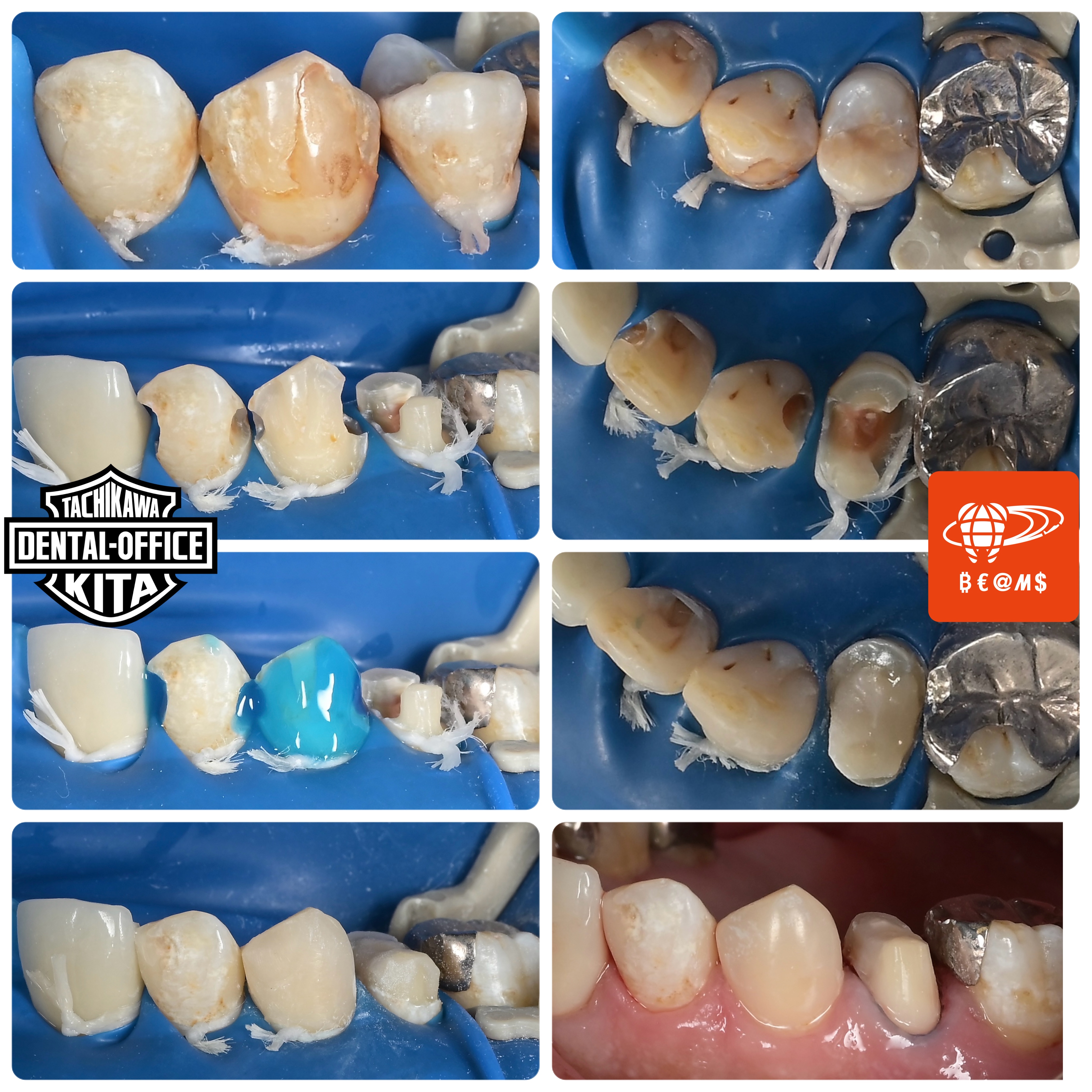 まだまだDirect Restoration