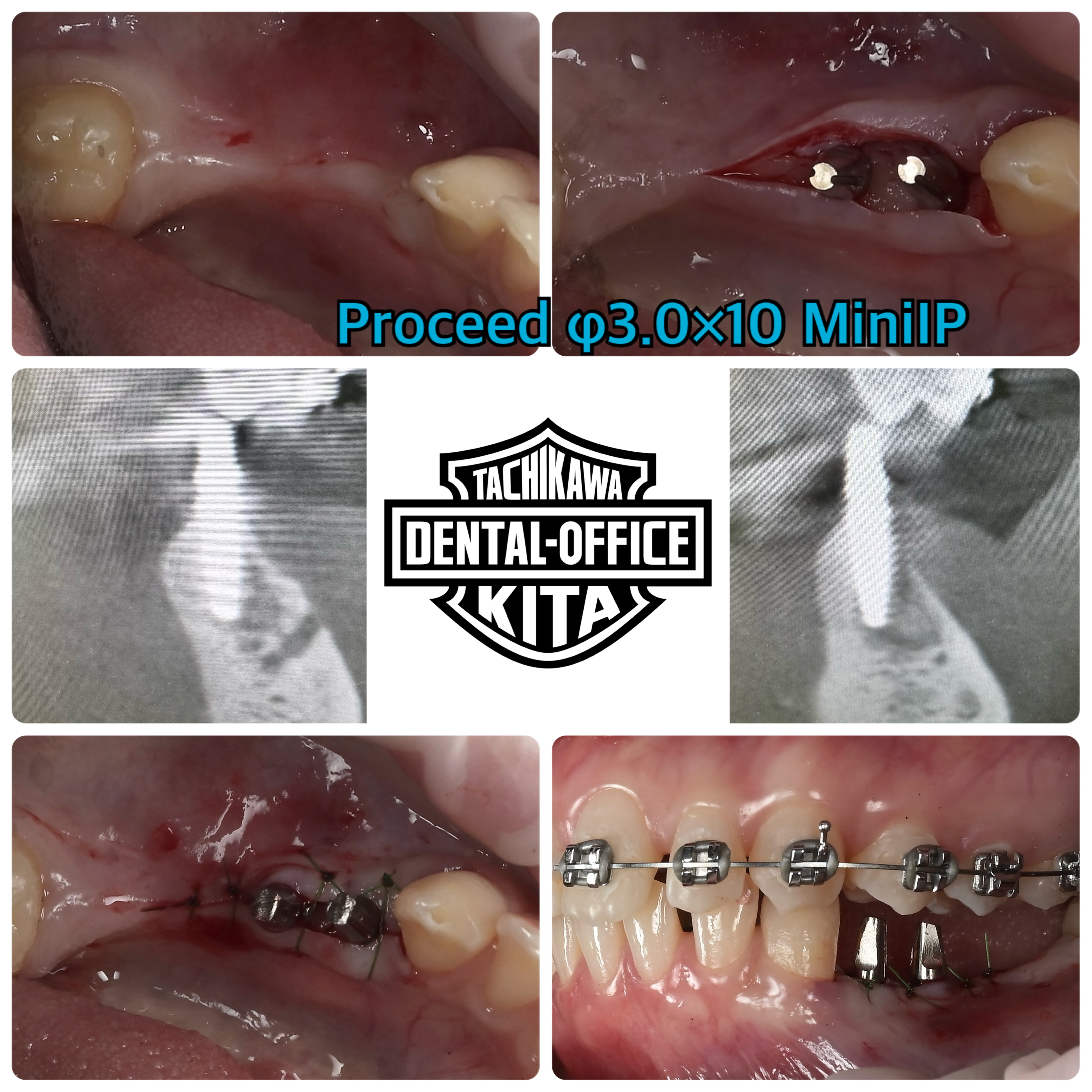 矯正のためのミニインプラント