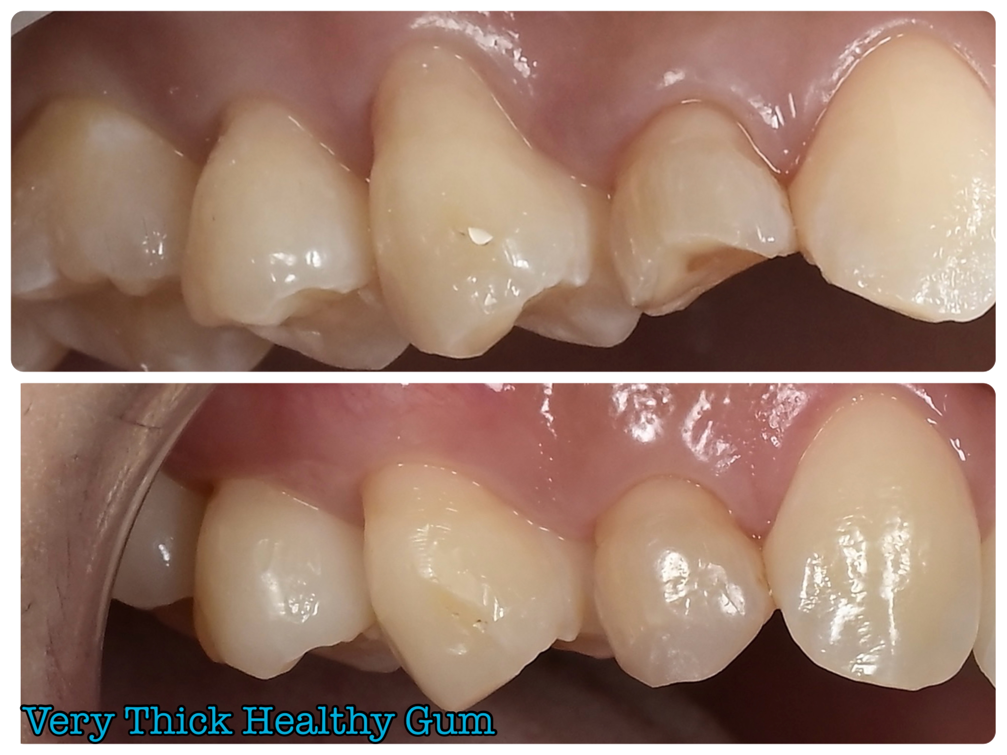 乳歯も残して歯茎も再生